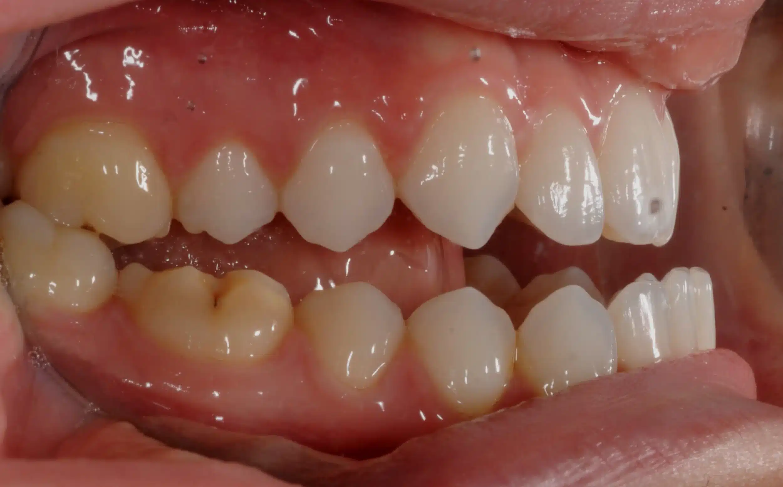 130950- INITIAL 11-23-13 - 130950 - Ines Castro - initial 11 - Intraoral Right.jpg
