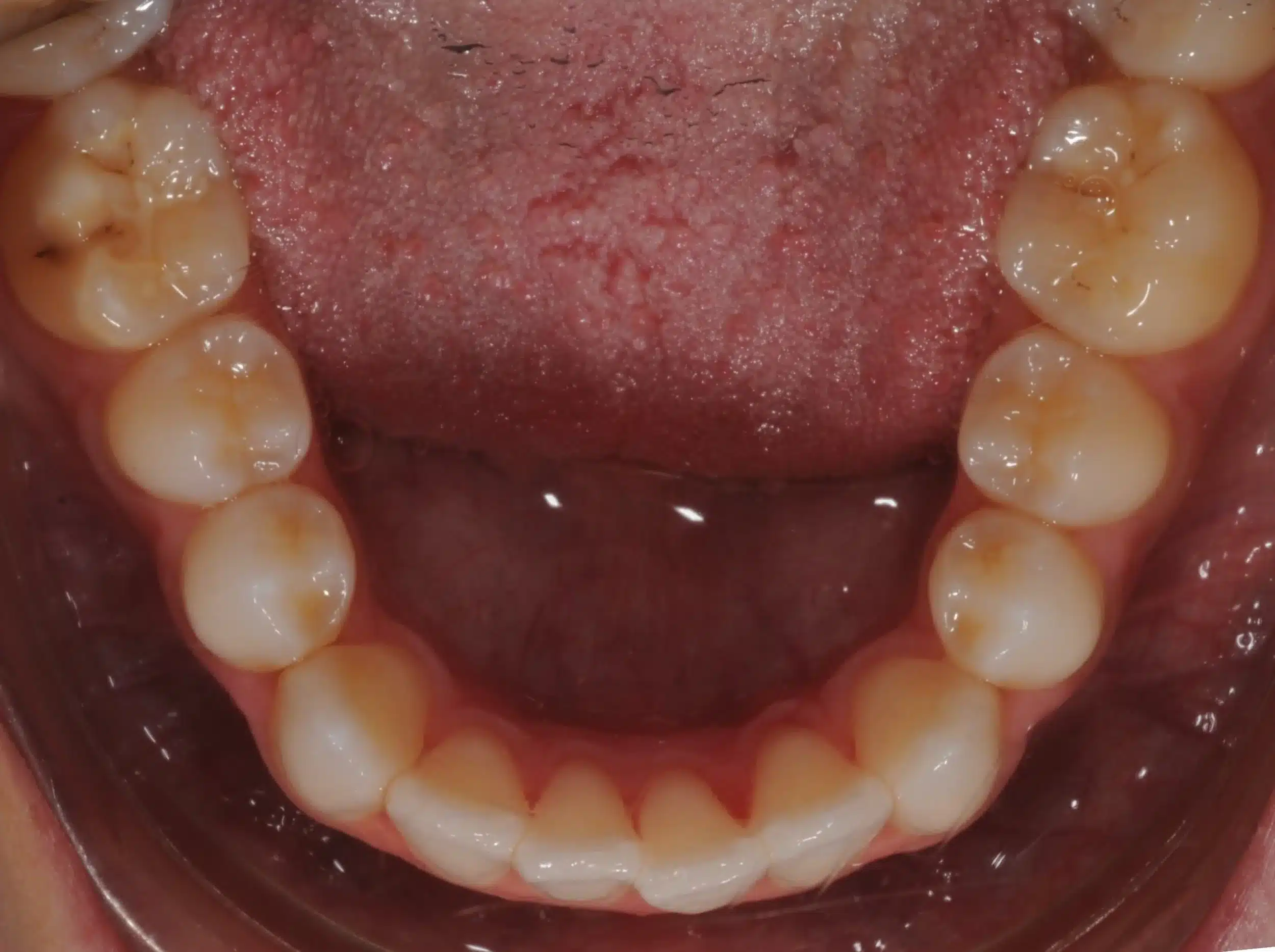 130950- INITIAL 11-23-13 - 130950 - Ines Castro - initial 11 - Occlusal Lower.jpg