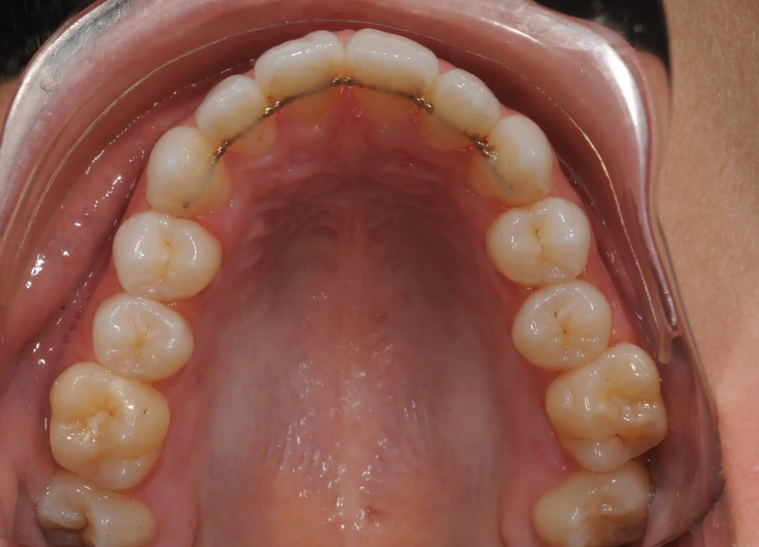 130950- INITIAL 11-23-13 - 130950 - Ines Castro - initial 11 - Occlusal Upper.jpg