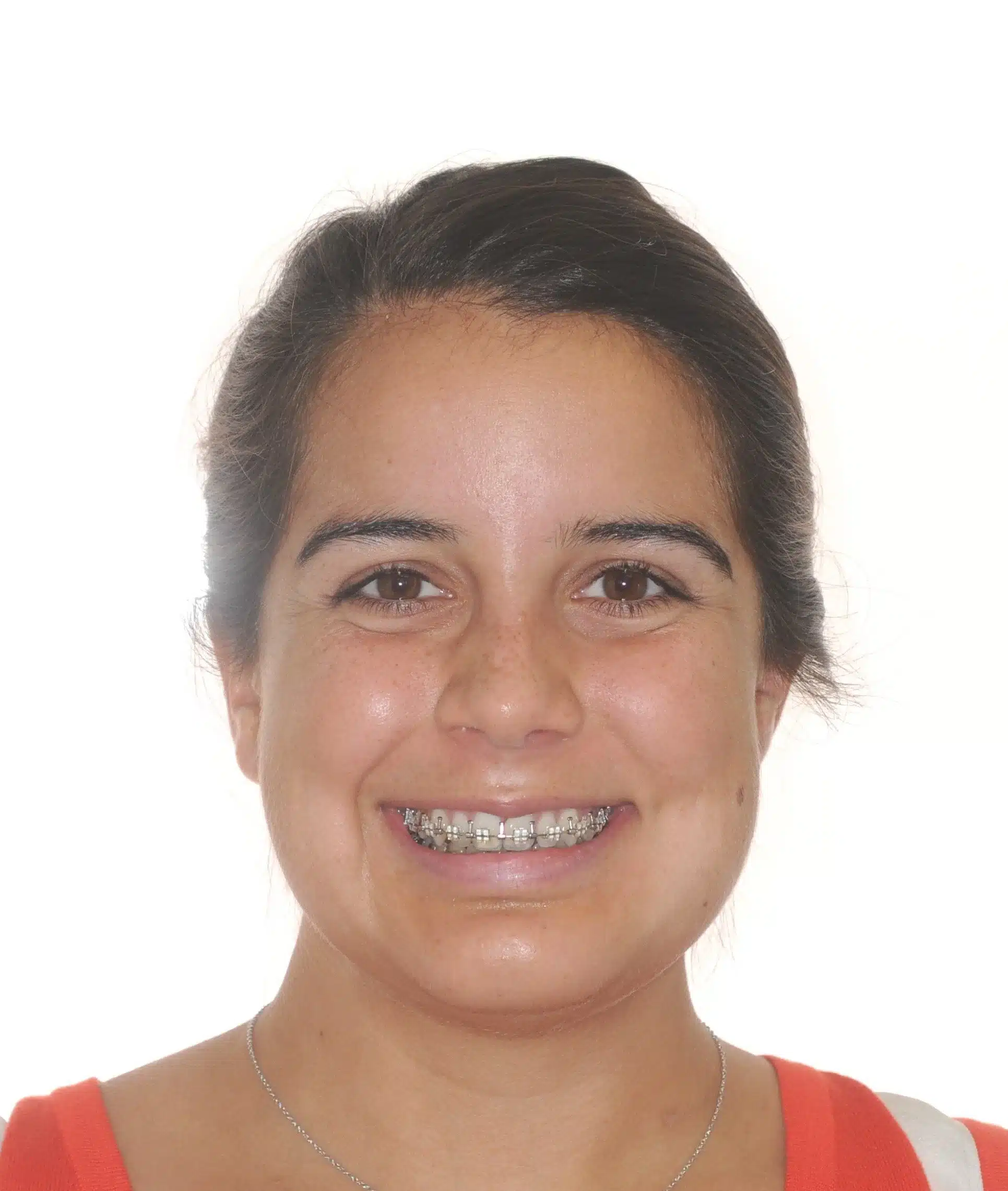 130950- pOST SURGICAL 1ST CHECK 7-11-2014 - 130950 - Ines Castro - post-surg 6 - Facial Front Smiling.jpg