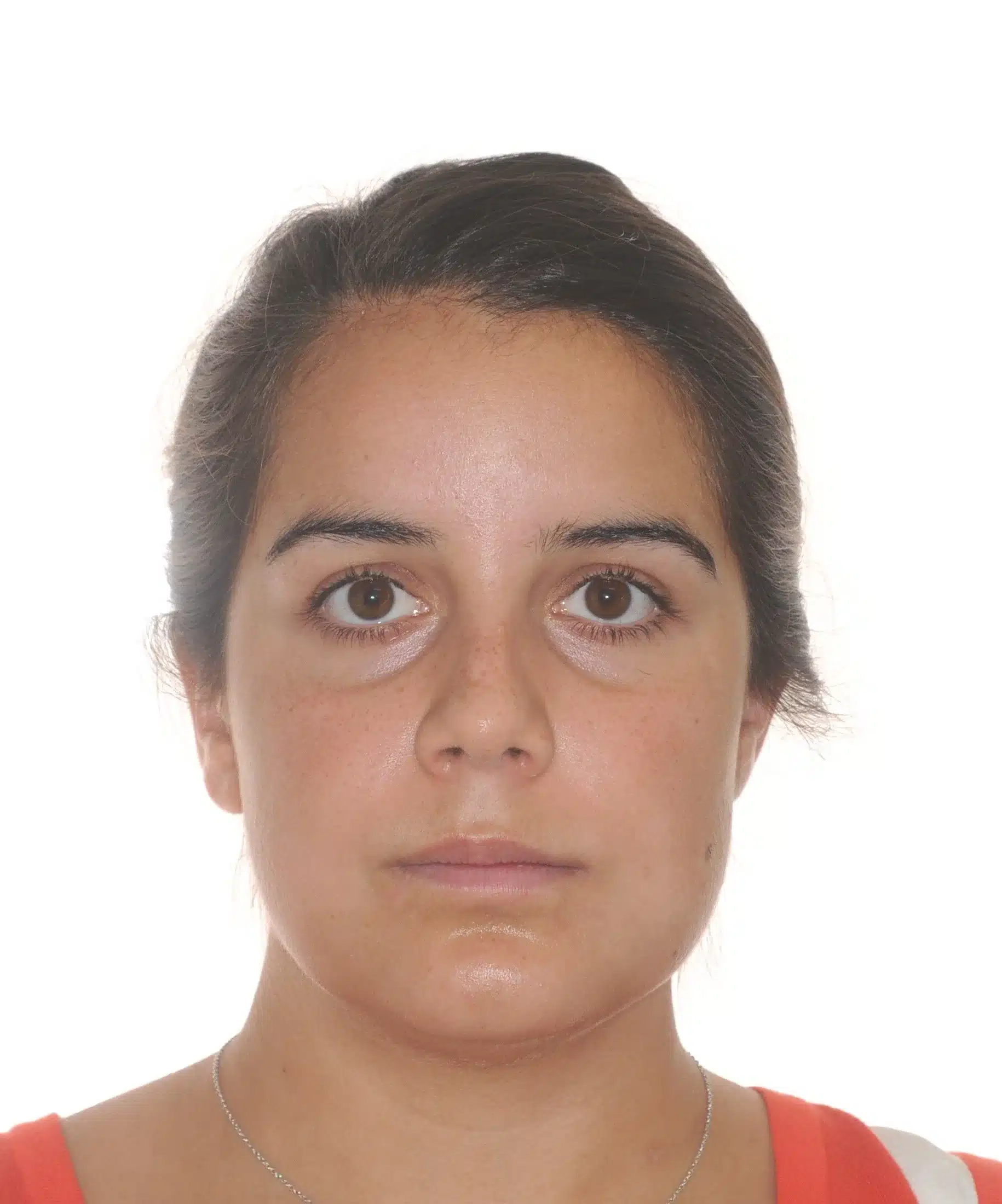 130950- pOST SURGICAL 1ST CHECK 7-11-2014 - 130950 - Ines Castro - post-surg 6 - Facial Front.jpg