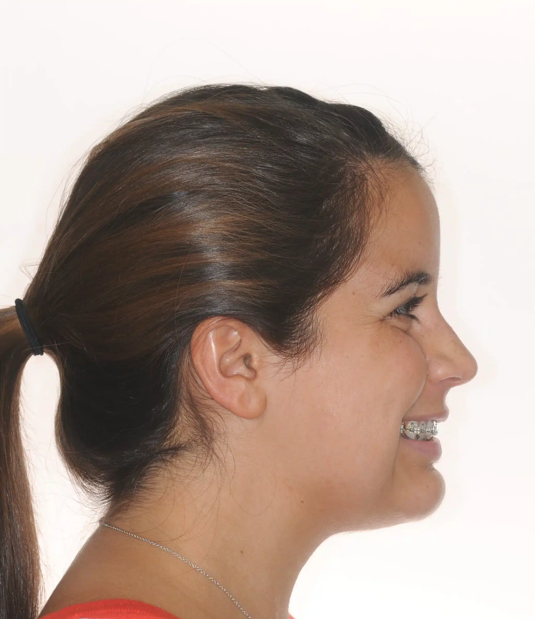 130950- pOST SURGICAL 1ST CHECK 7-11-2014 - 130950 - Ines Castro - post-surg 6 - Facial Profile Smiling.jpg