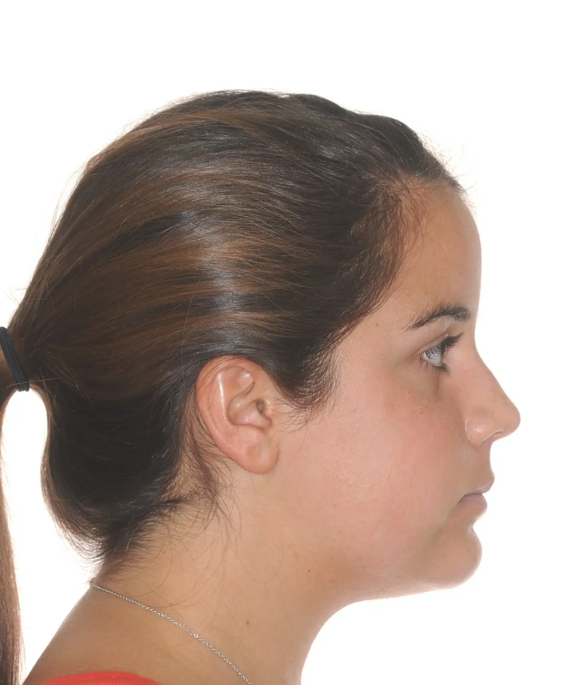 130950- pOST SURGICAL 1ST CHECK 7-11-2014 - 130950 - Ines Castro - post-surg 6 - Facial Profile.jpg