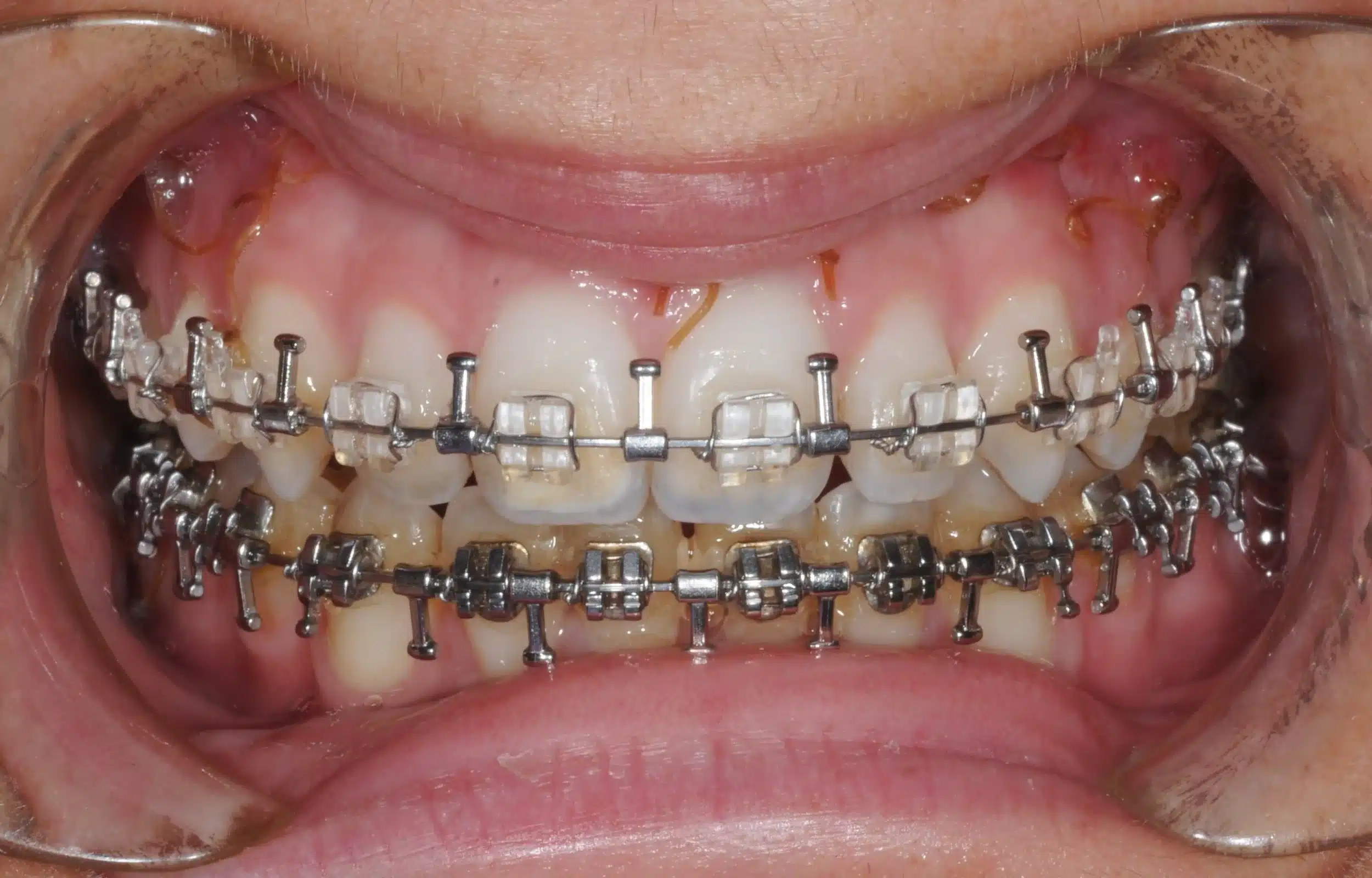 130950- pOST SURGICAL 1ST CHECK 7-11-2014 - 130950 - Ines Castro - post-surg 6 - Intraoral Center.jpg