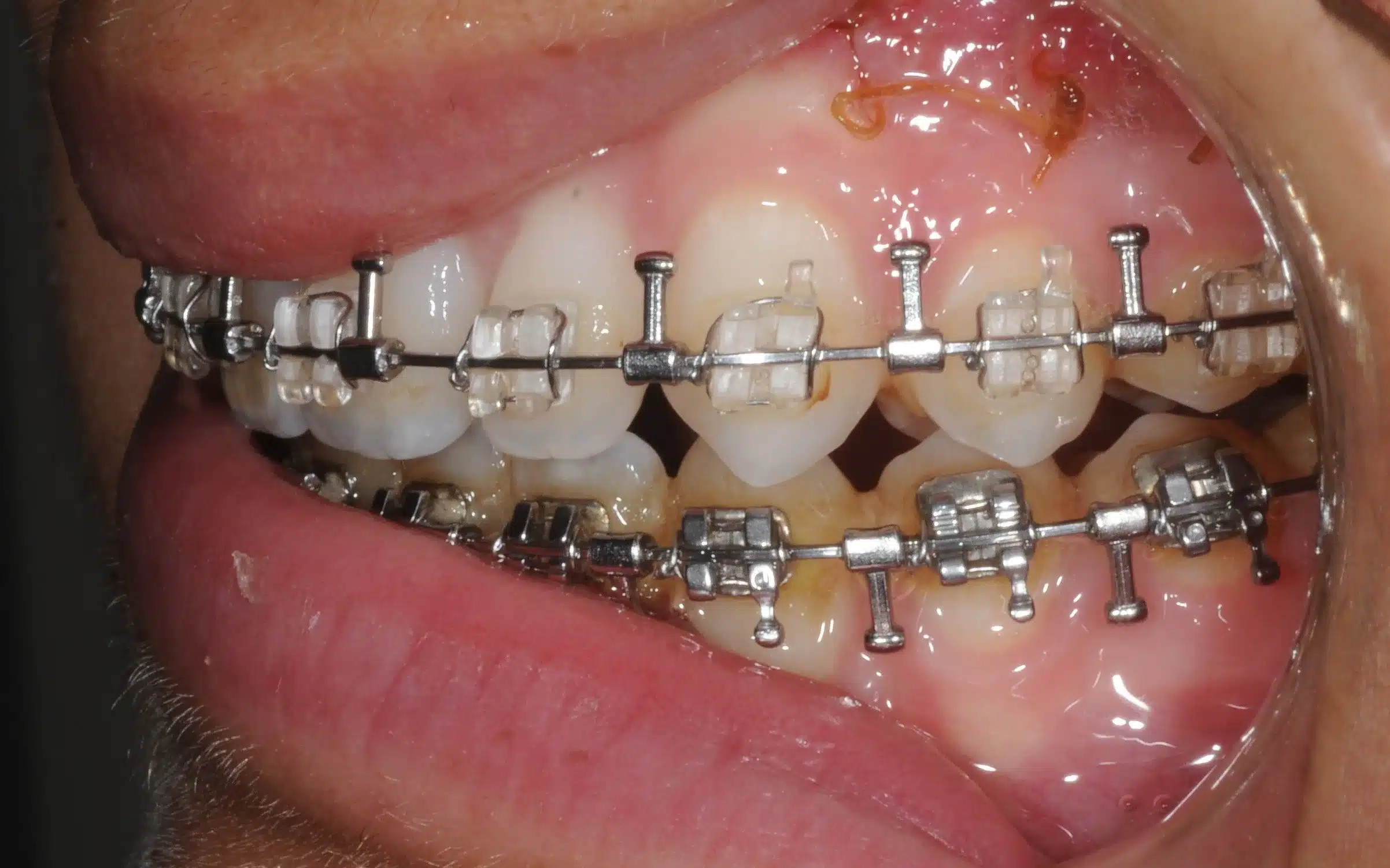 130950- pOST SURGICAL 1ST CHECK 7-11-2014 - 130950 - Ines Castro - post-surg 6 - Intraoral Left.jpg