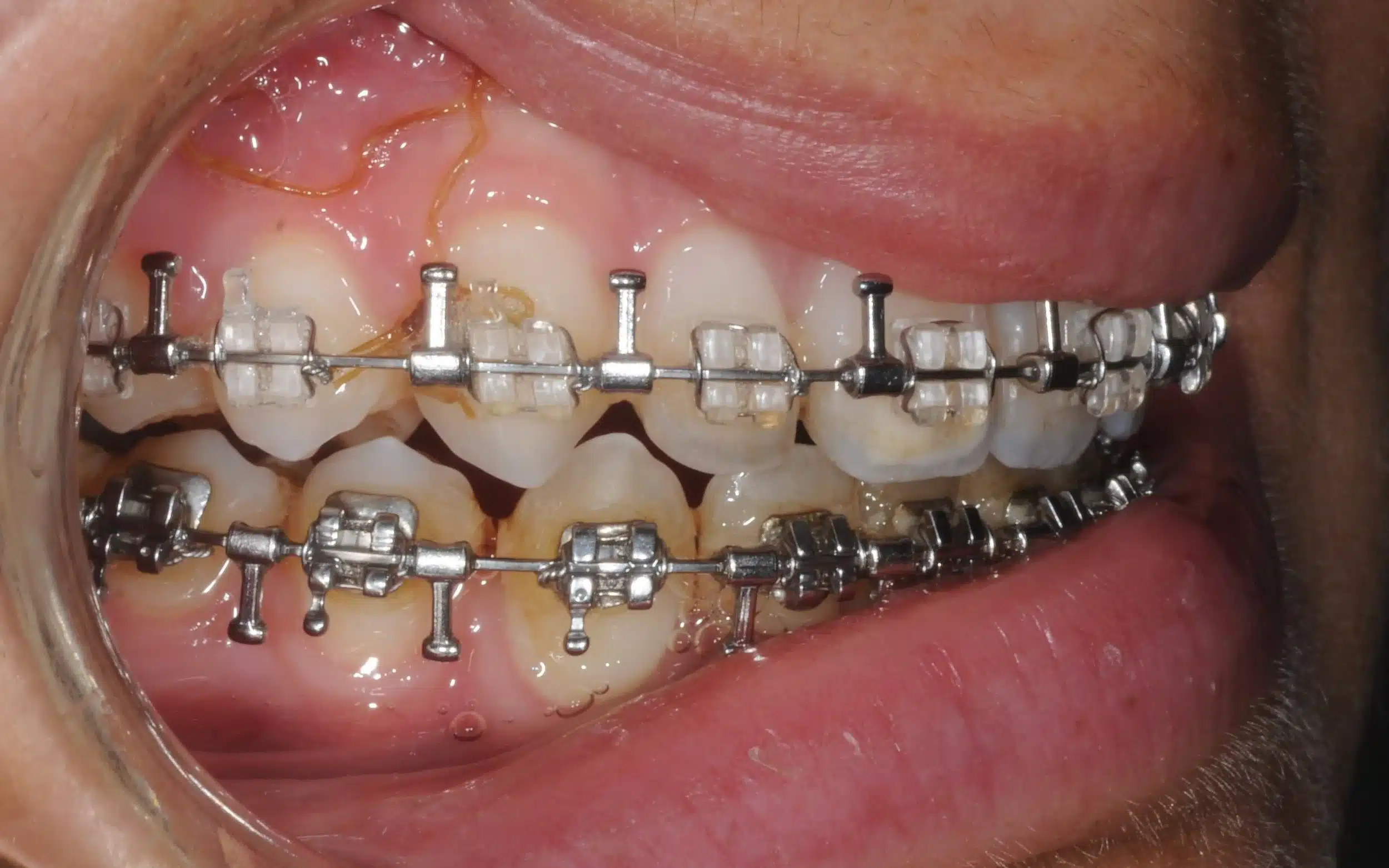 130950- pOST SURGICAL 1ST CHECK 7-11-2014 - 130950 - Ines Castro - post-surg 6 - Intraoral Right.jpg