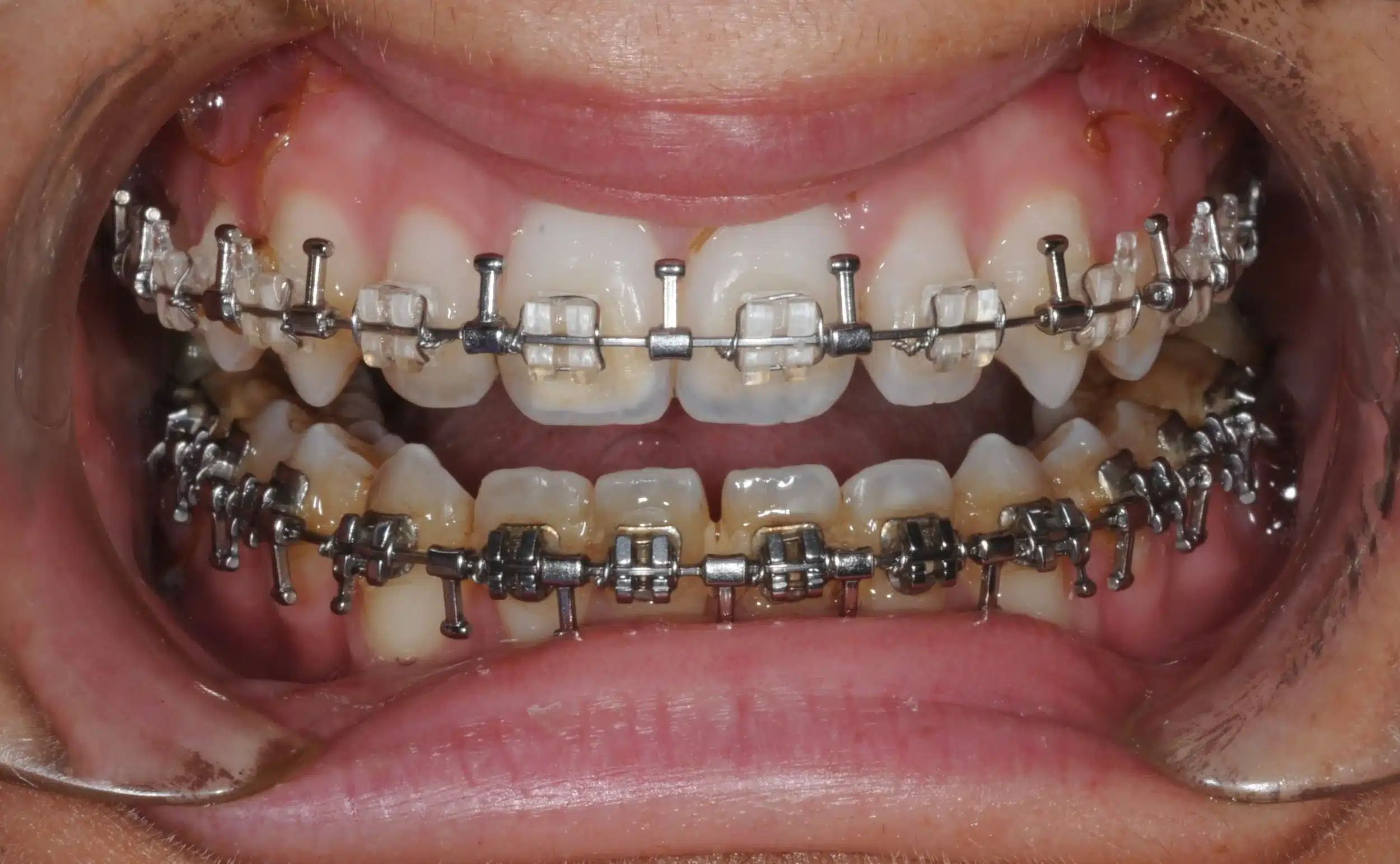 130950- pOST SURGICAL 1ST CHECK 7-11-2014 - 130950 - Ines Castro - post-surg 6 - Intraoral Misc.jpg