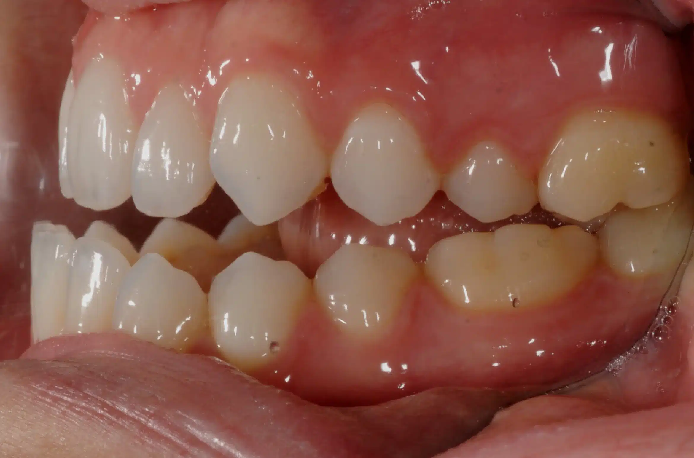 before bite on left side.jpg