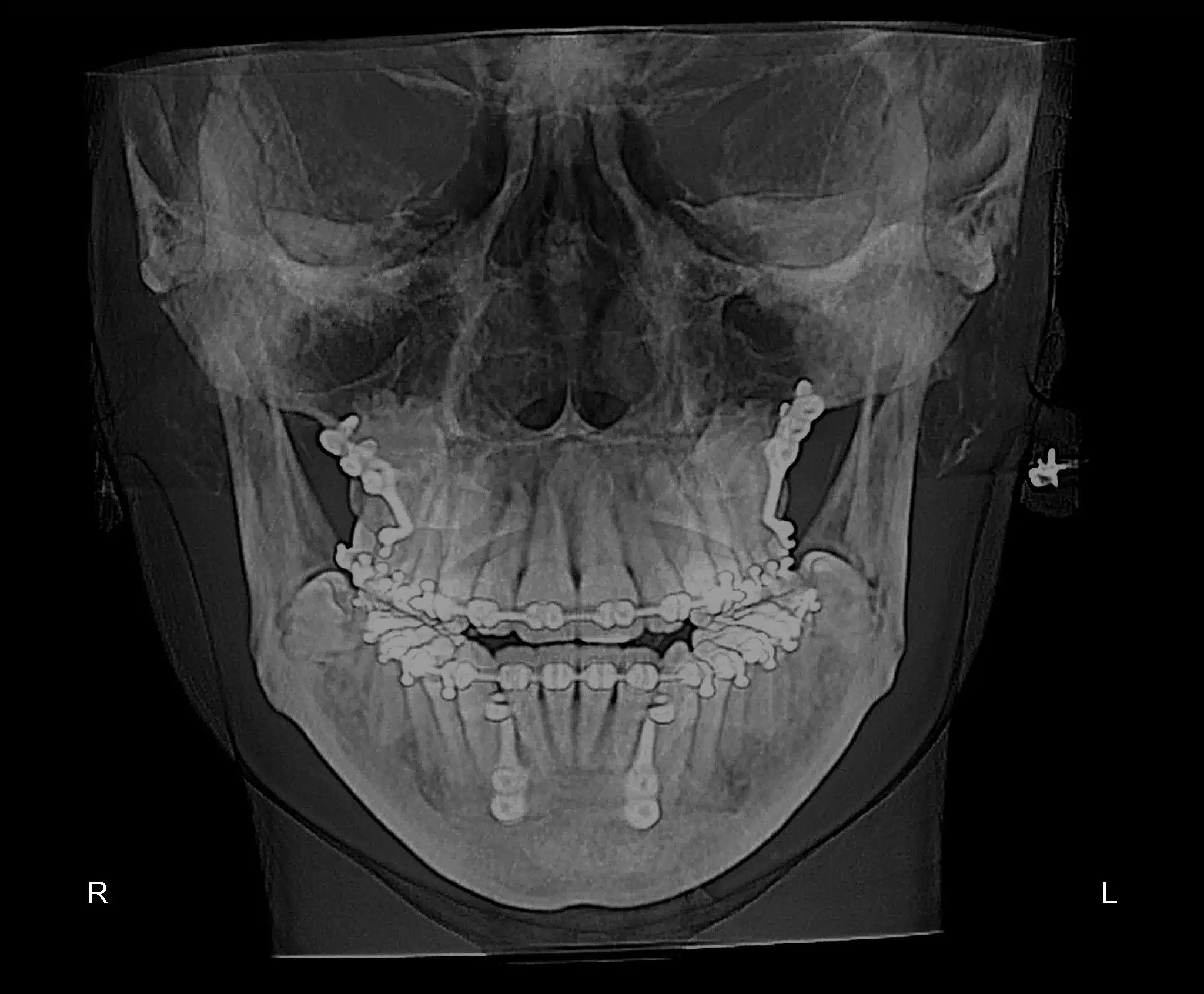 Class III NonSurgical Best NYC Orthodontist 3.jpeg