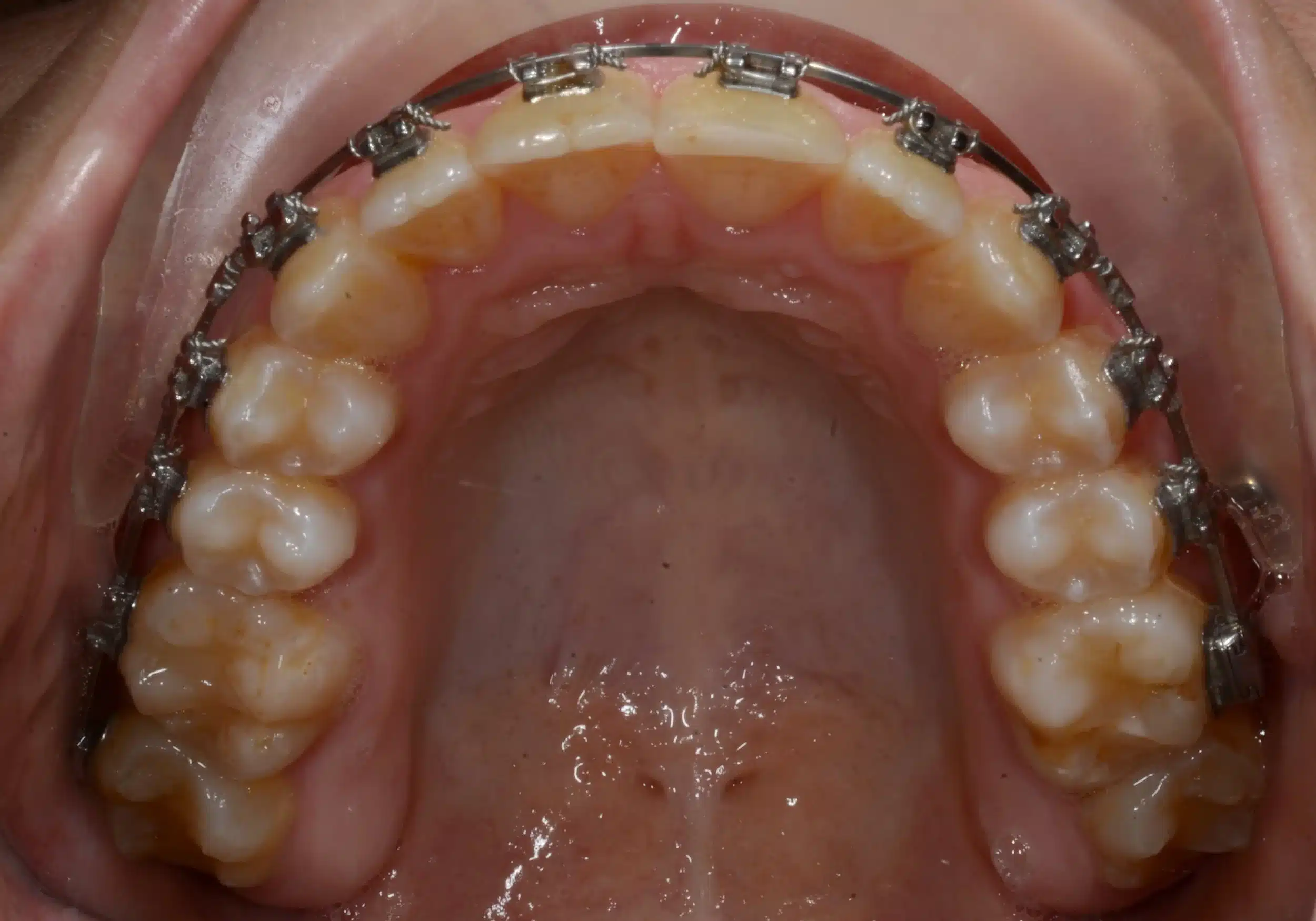 Class III NonSurgical Best NYC Orthodontist 4.jpeg