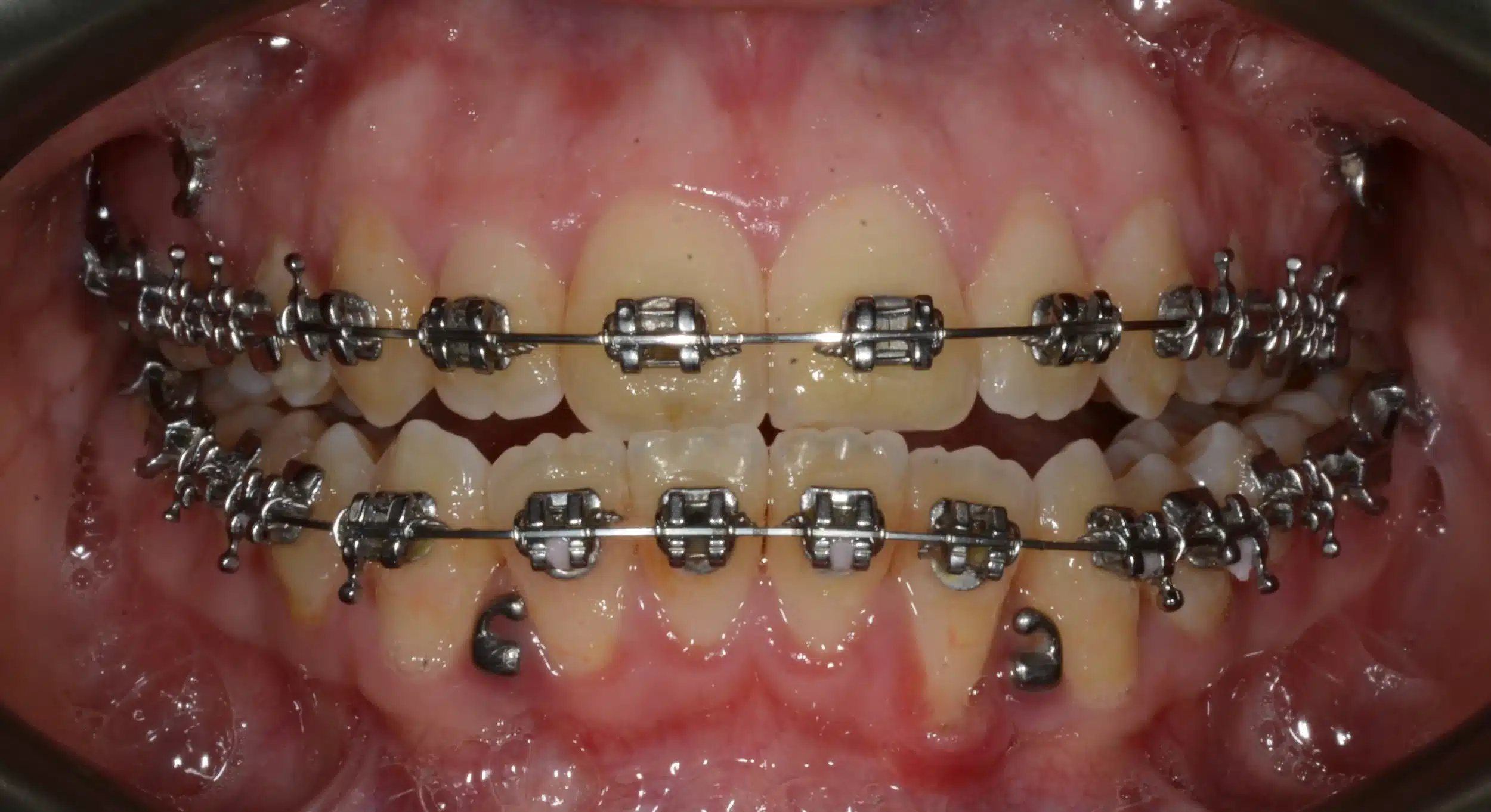 Class III NonSurgical Best NYC Orthodontist 5 .jpeg