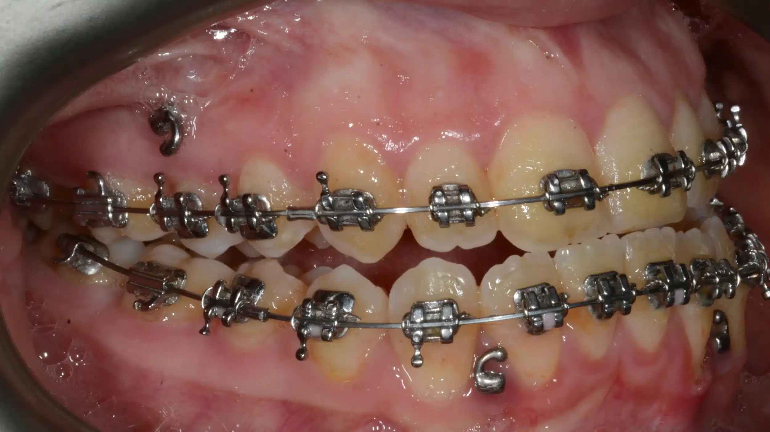 Class III NonSurgical Best NYC Orthodontist 6.jpeg