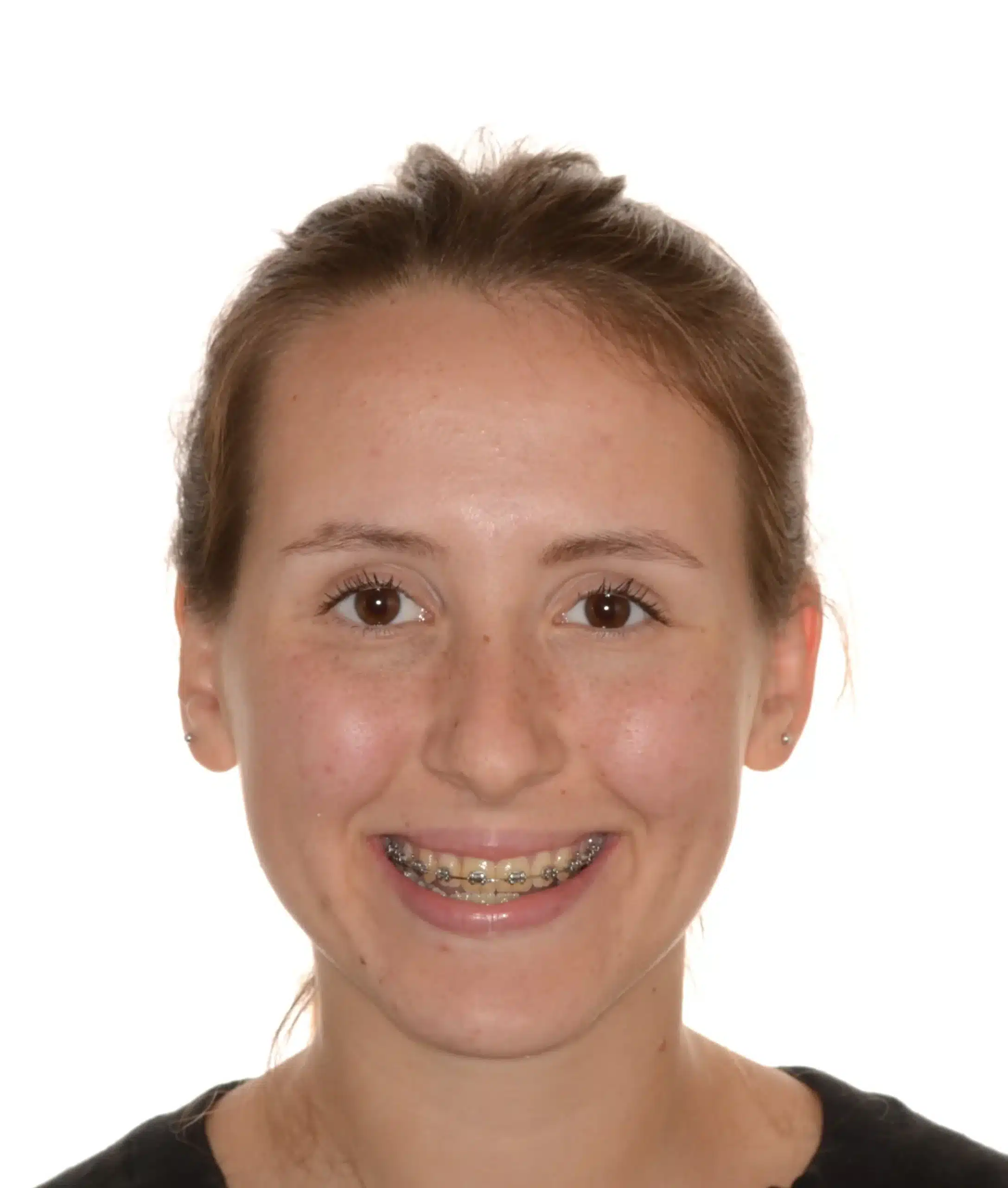 Class III NonSurgical Best NYC Orthodontist 7.jpeg