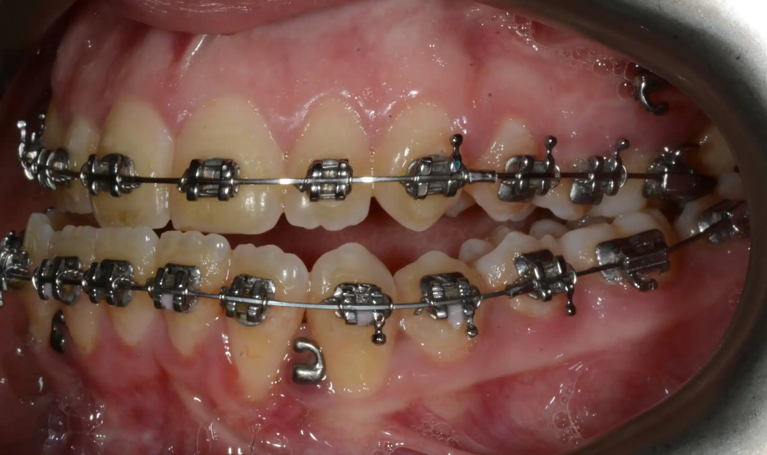 Class III NonSurgical Best NYC Orthodontist 8 .jpeg
