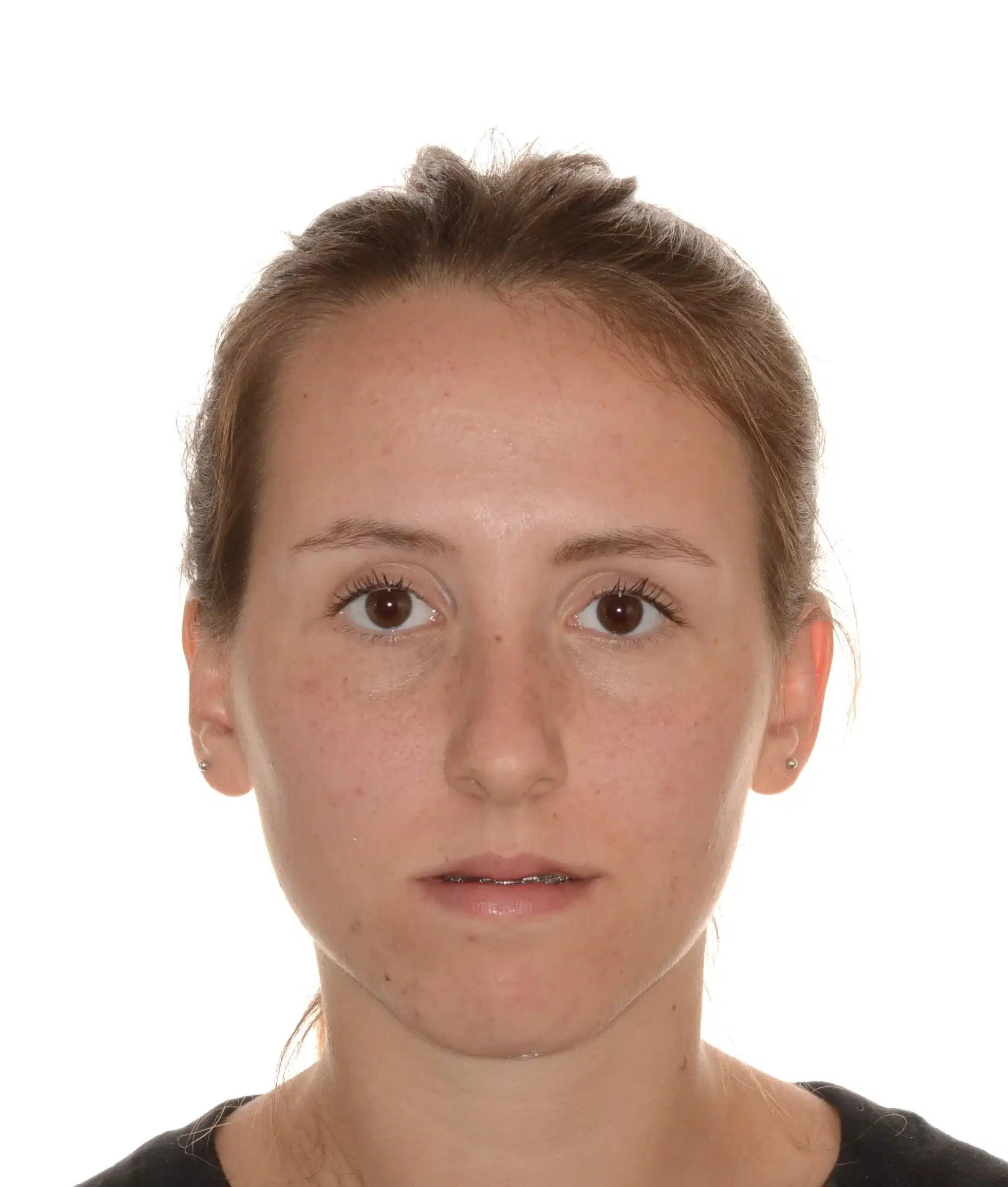 Class III Nonsurgical Best NYC Orthodontist.jpeg