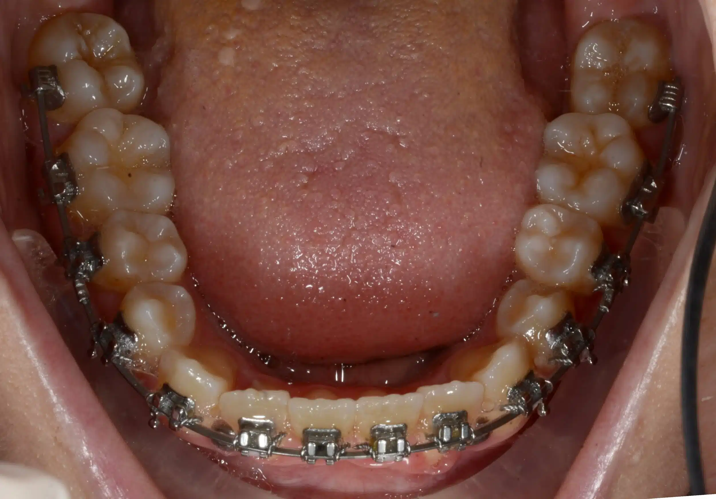 Class III Nonsurgical NYC Best Orthodontist 1.jpeg