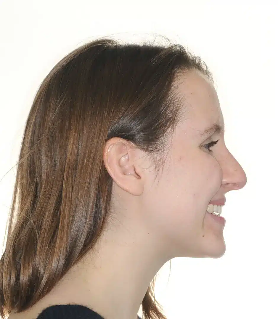 Class III NonSurgrey Best NYC Orthodontist 2jpeg.jpeg