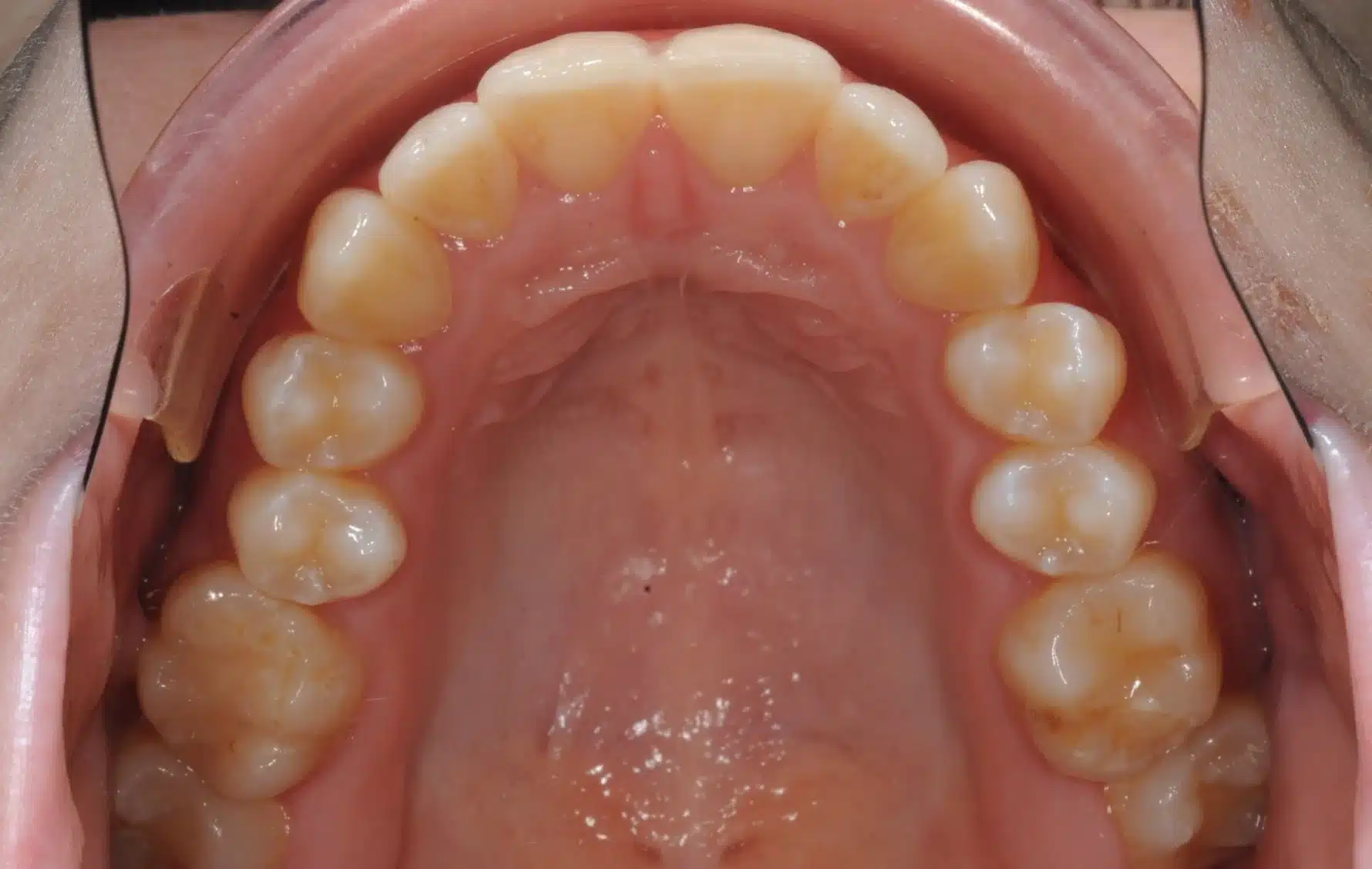 Class III NonSurgrey Best NYC Orthodontist 3.jpeg