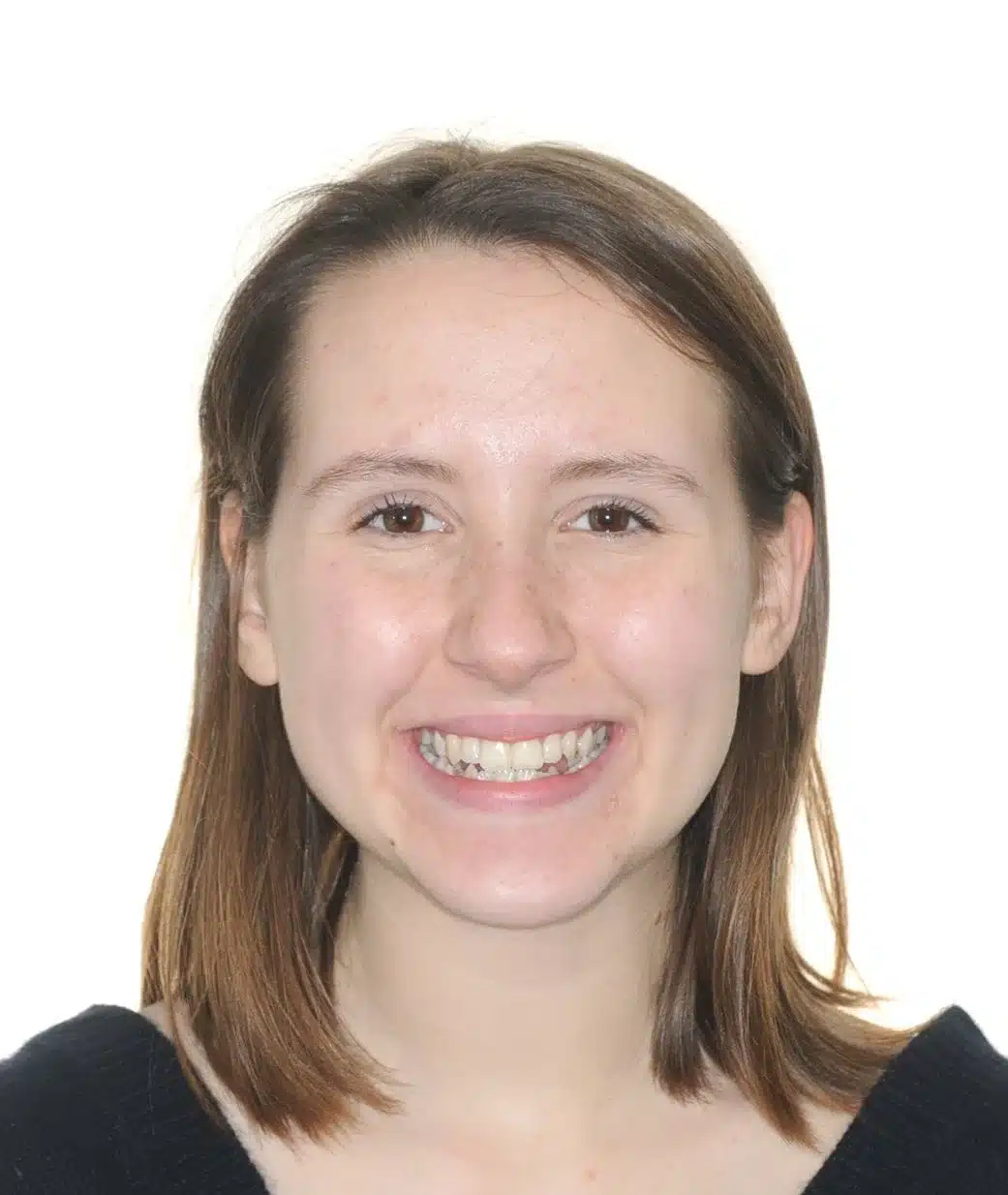 Class III NonSurgrey Best NYC Orthodontist 4.jpeg