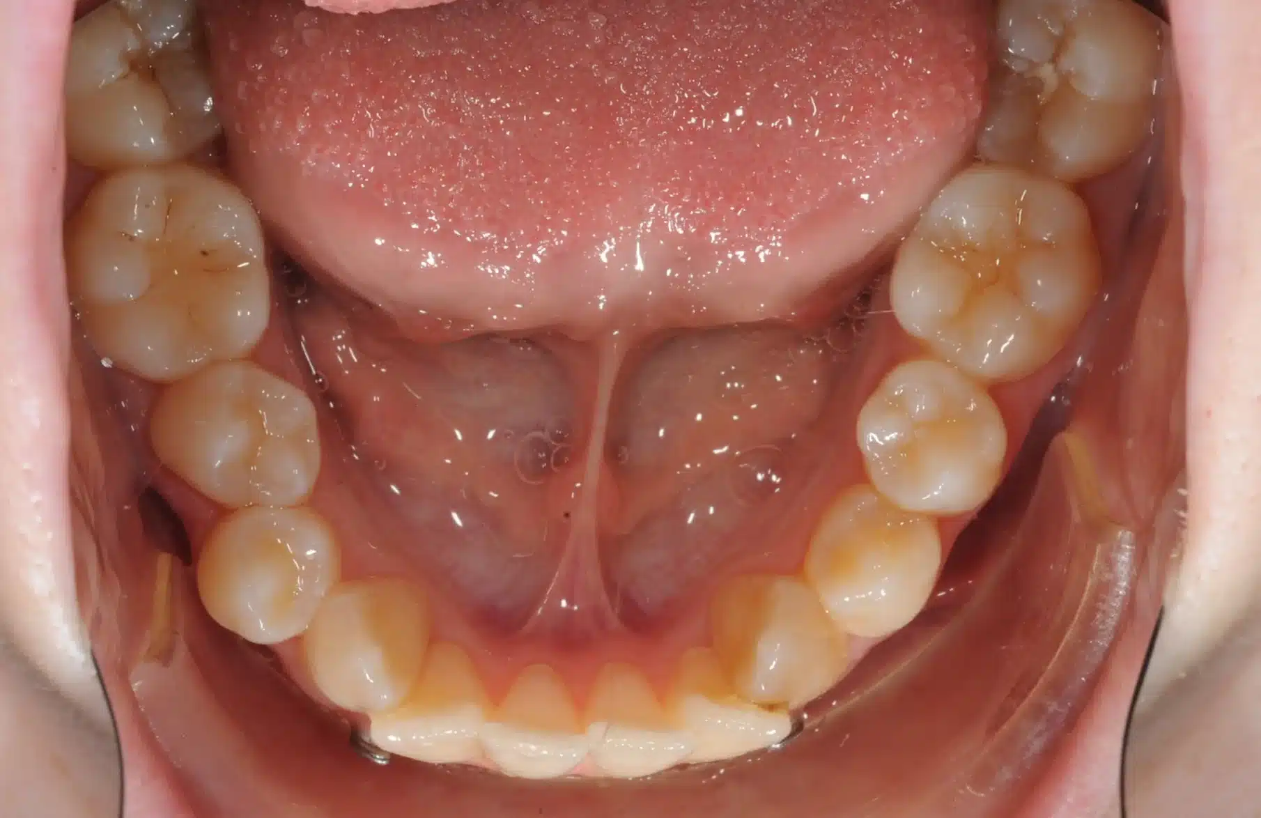 Class III NonSurgrey Best NYC Orthodontist 7jpeg.jpeg