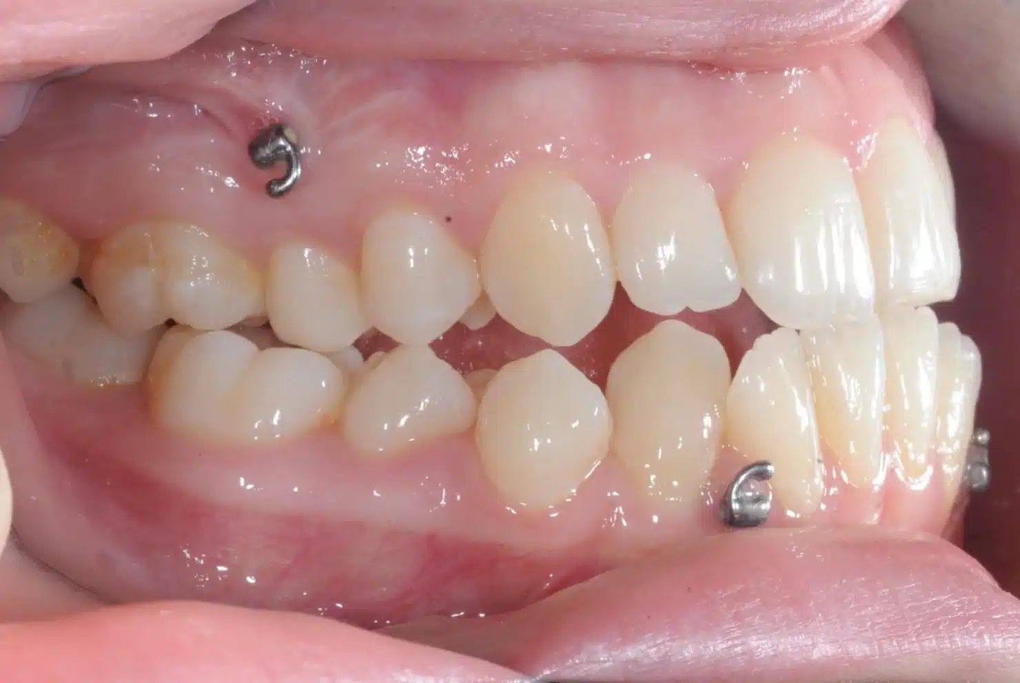 Class III NonSurgrey Best NYC Orthodontist.jpeg