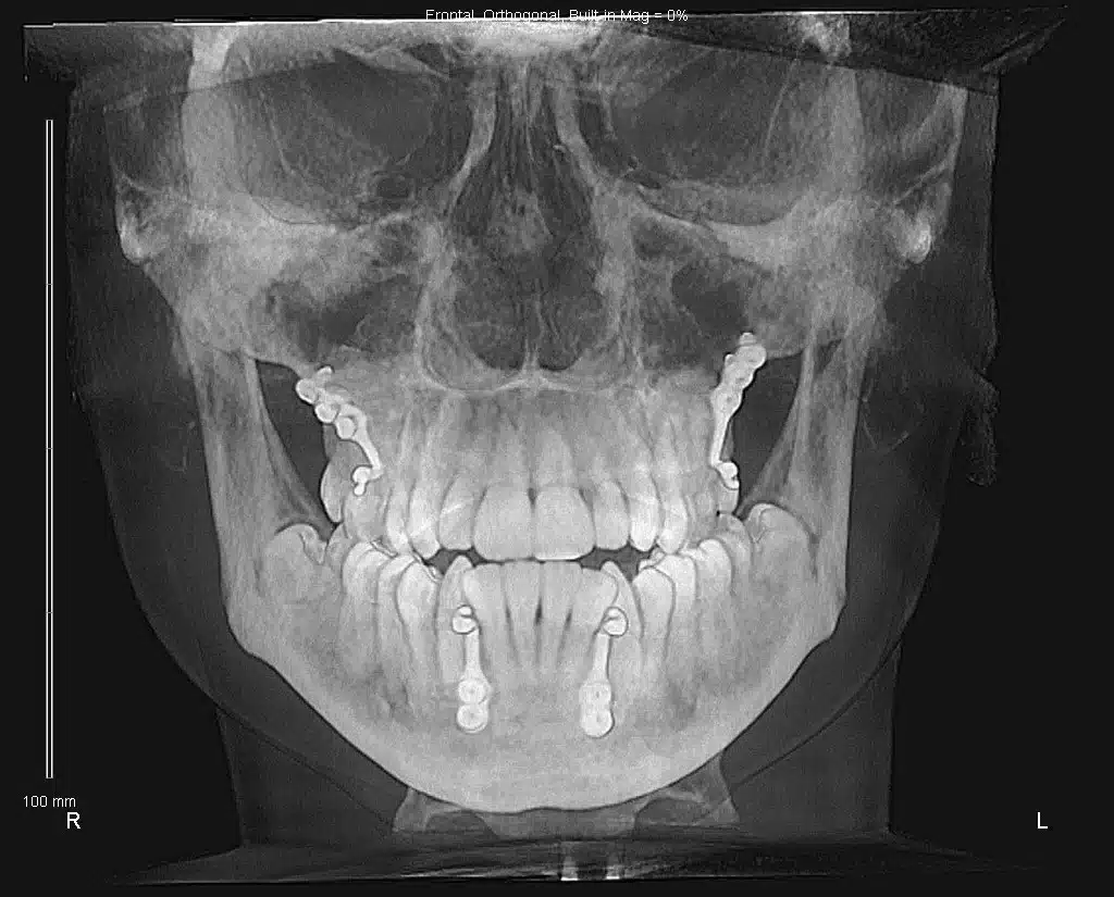 Class III NYC Best Orthodontist 1.jpg