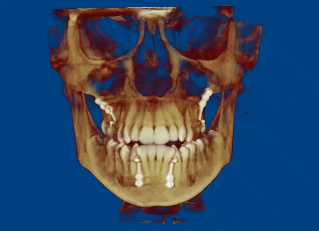 Class III- NYC Best Orthodontist.jpg