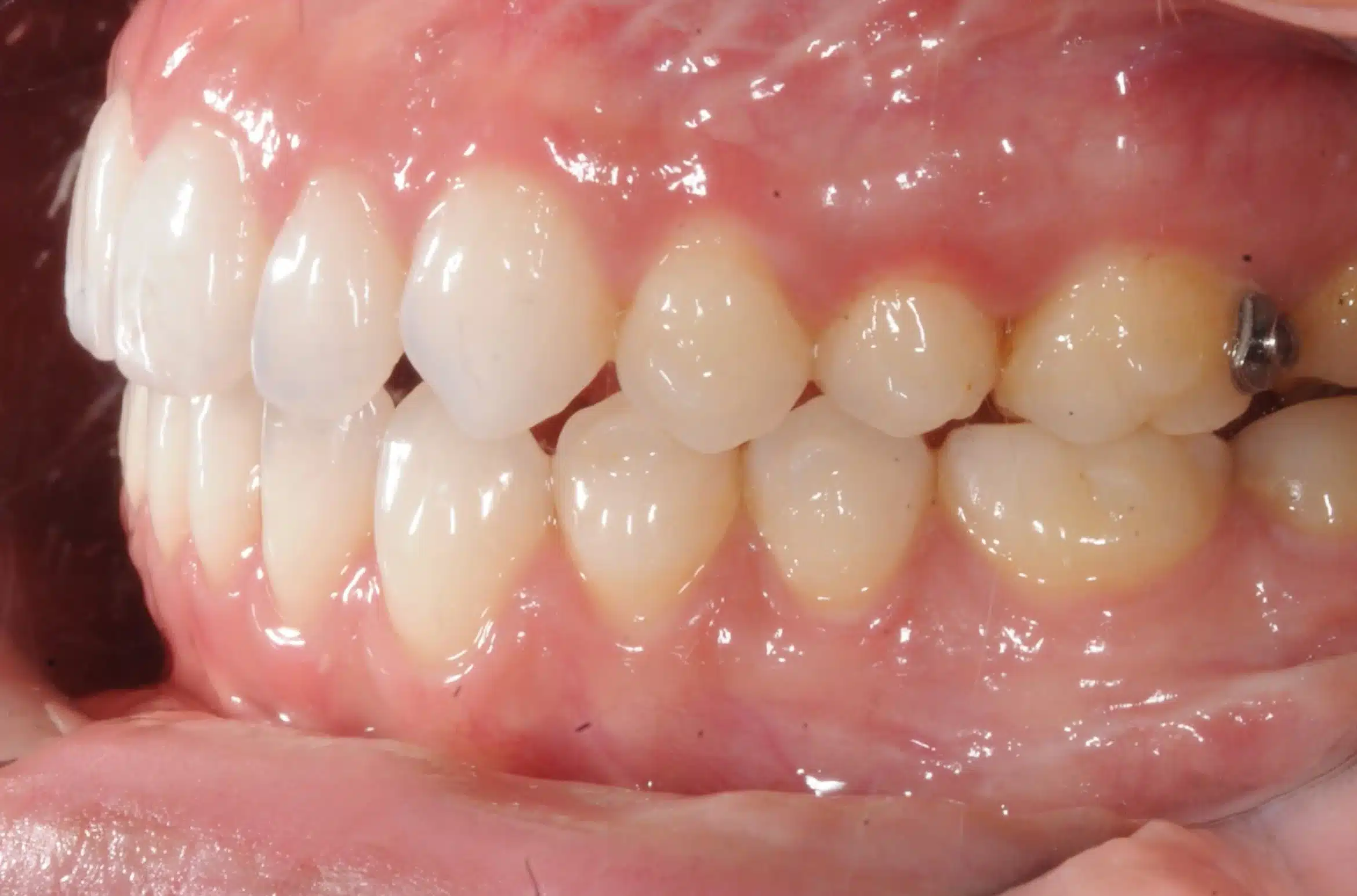 final bite on left side.jpg