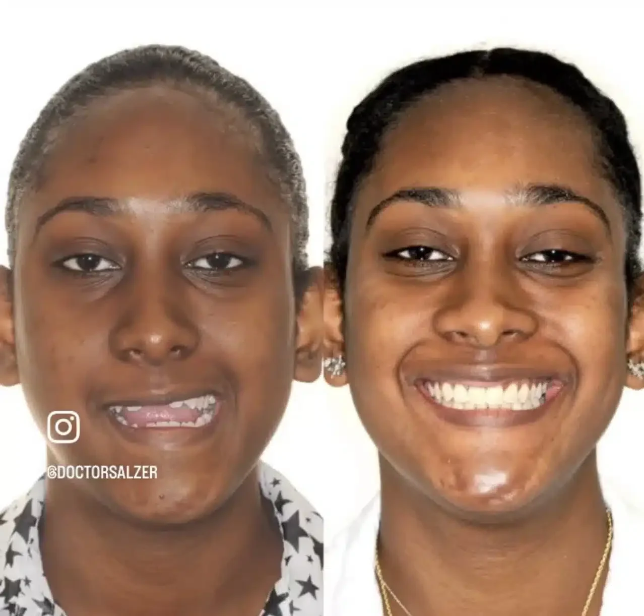 Before and after surgical orthodontics NYC jaw correction results at Lemchen Salzer Orthodontics