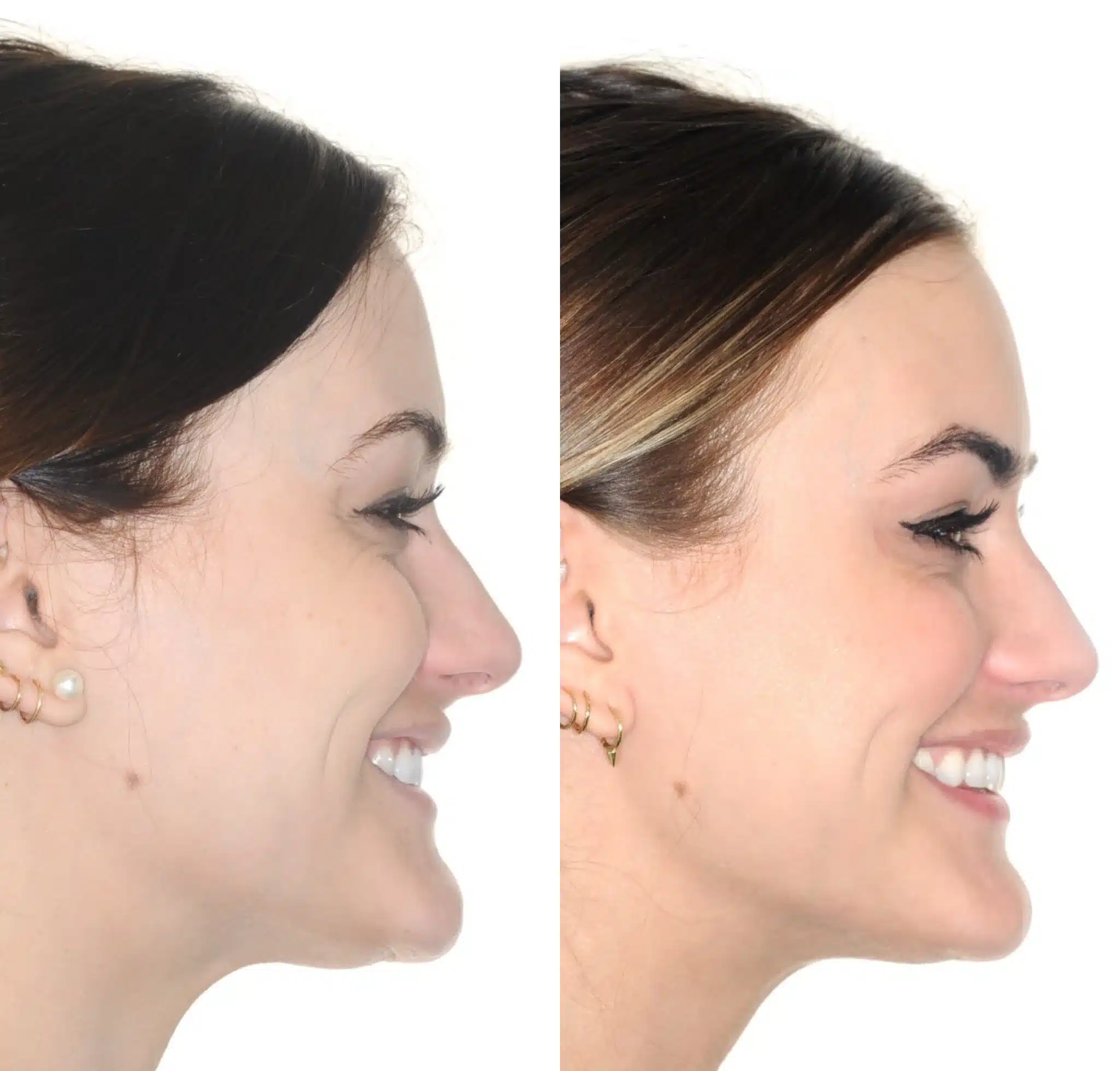 Before & After: In these images, you can notice that the patient’s smile is much larger, her lips are fuller, and her jawline is more pronounced.