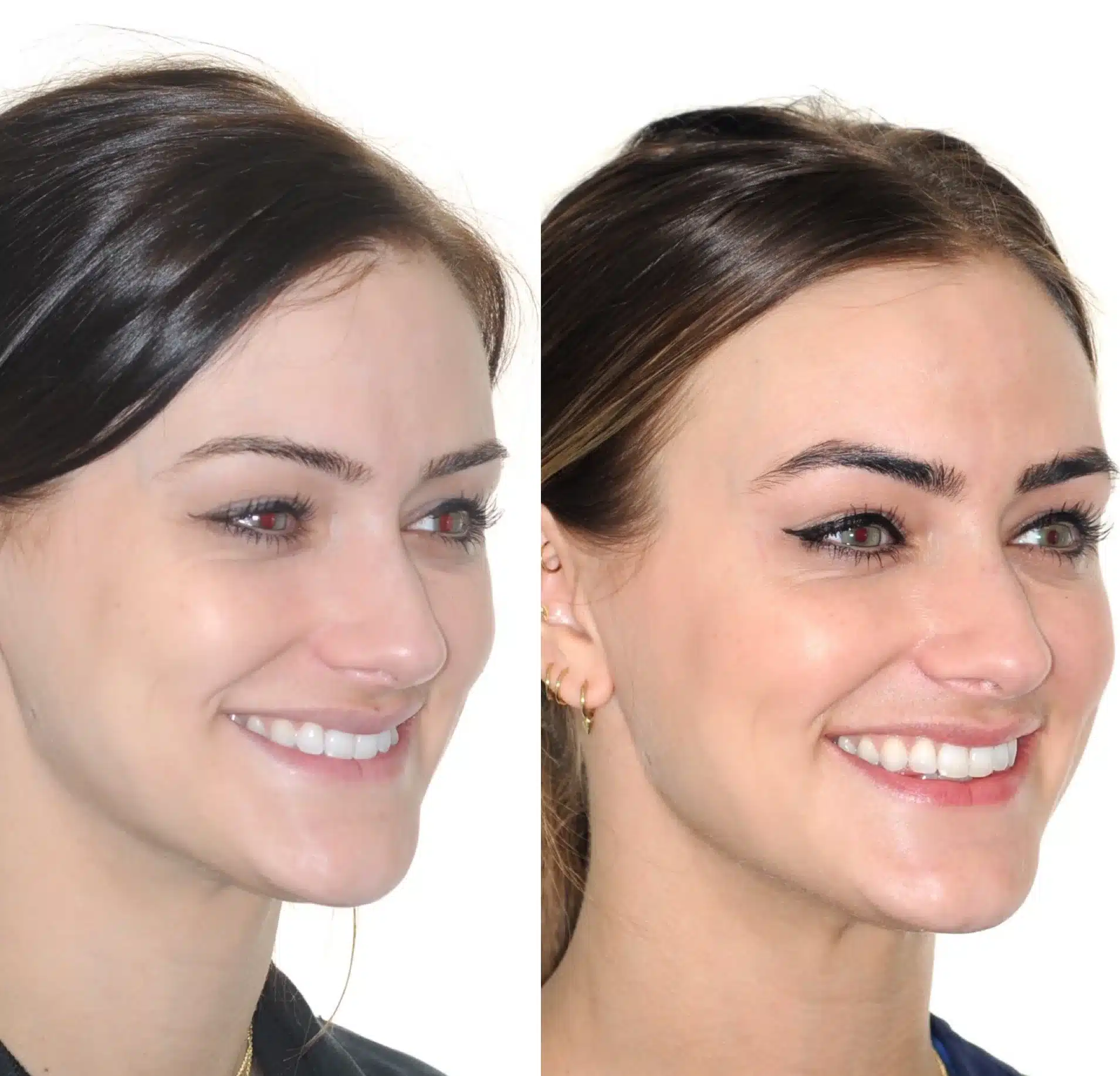 Before & After: In these images, you can clearly see that this patient’s smile is much wider and her jaw has moved forward creating a more youthful appearance.