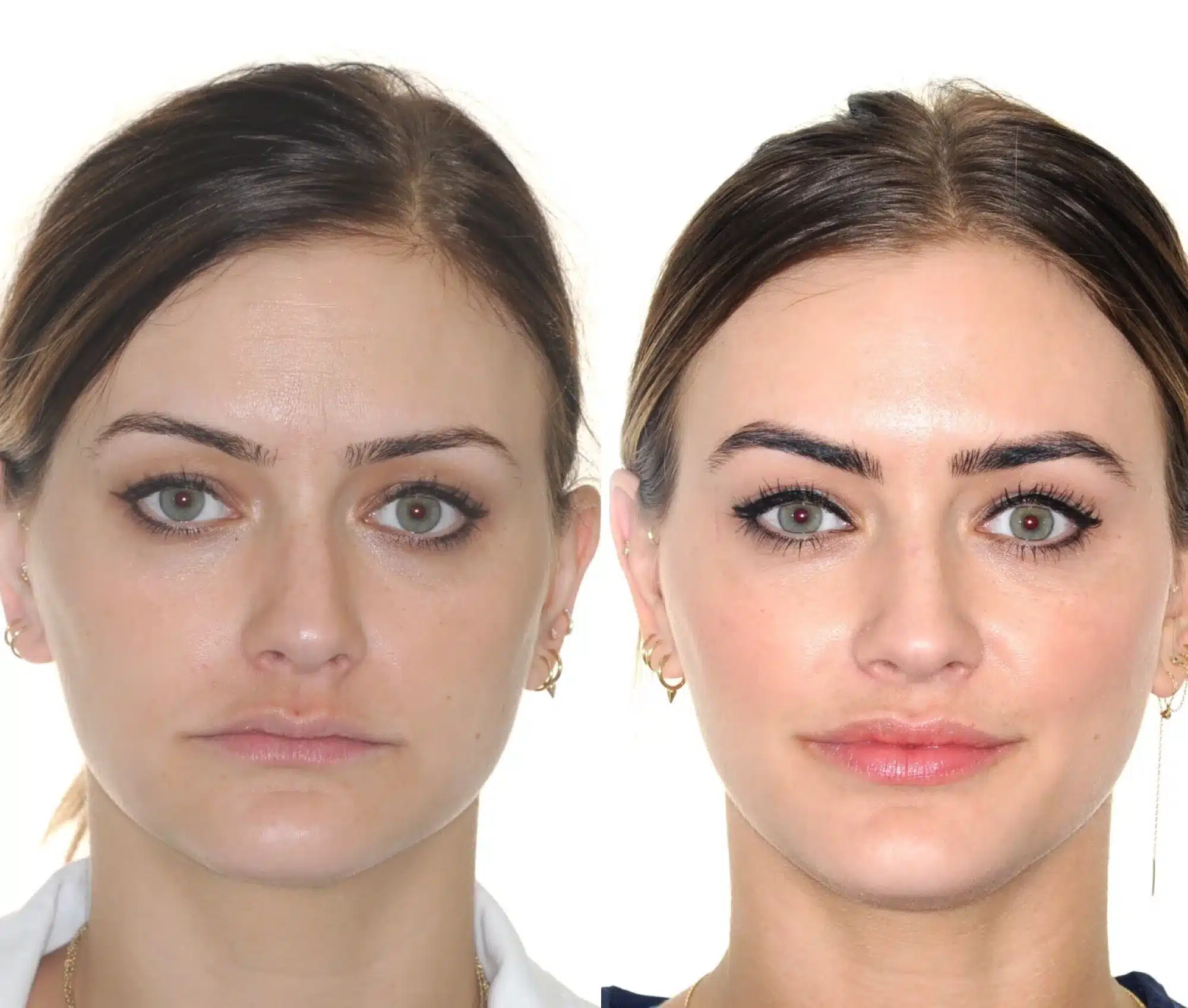 Before & After: These images clearly depict how this patient’s lips became much fuller after her Invisalign treatment.