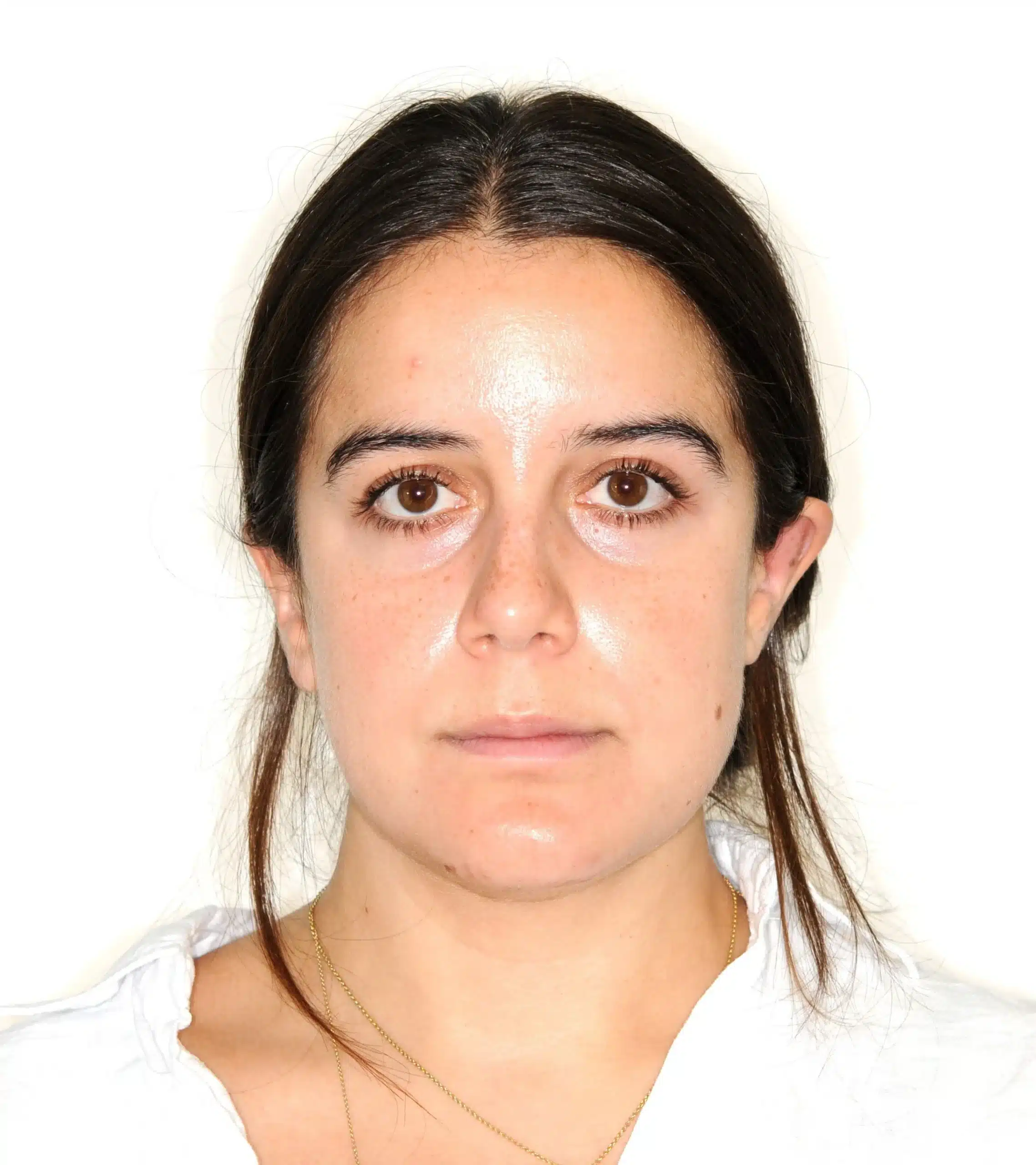 Invisalign begins in 2022 - 130950 - Ines Castro - Diagnostic 17 - Facial Front.jpg