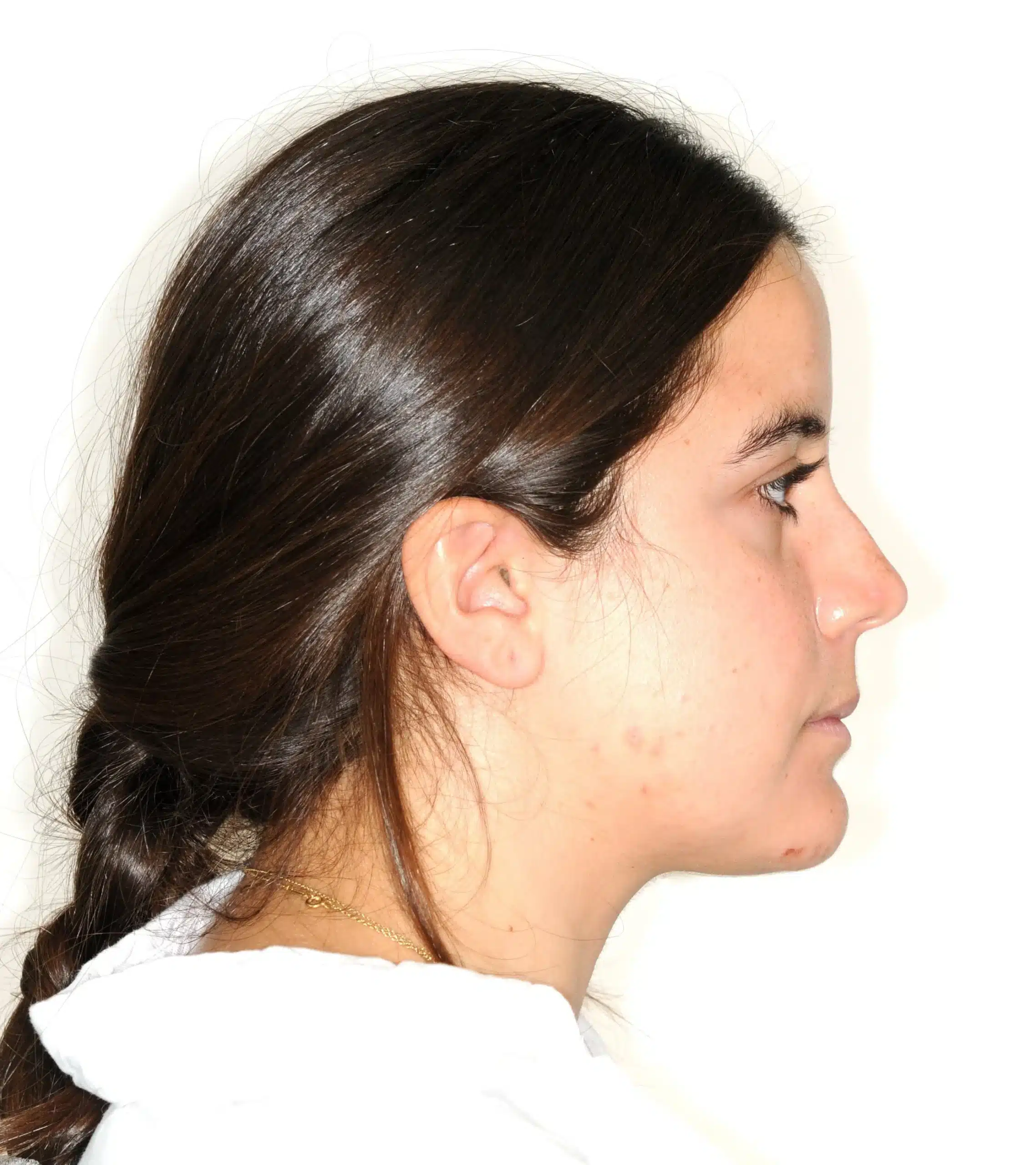 Invisalign begins in 2022 - 130950 - Ines Castro - Diagnostic 17 - Facial Profile.jpg