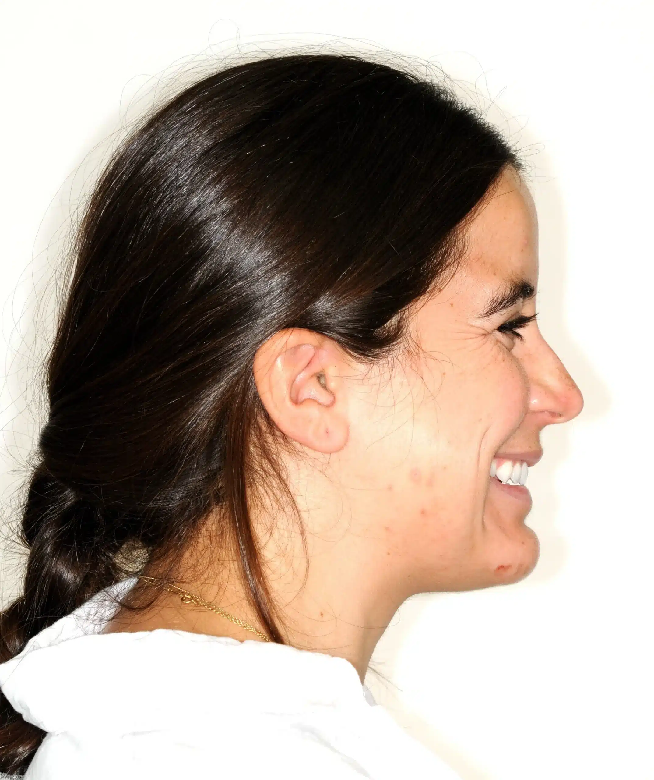 Invisalign begins in 2022 - 130950 - Ines Castro - Diagnostic 17 - Facial Profile Smiling.jpg
