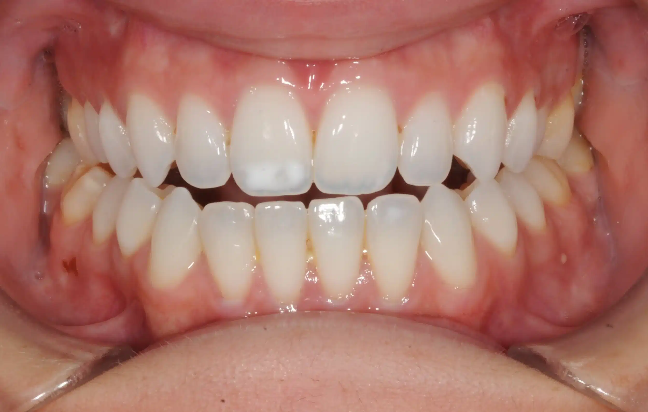 Invisalign begins in 2022 - 130950 - Ines Castro - Diagnostic 17 - Intraoral Center.jpg