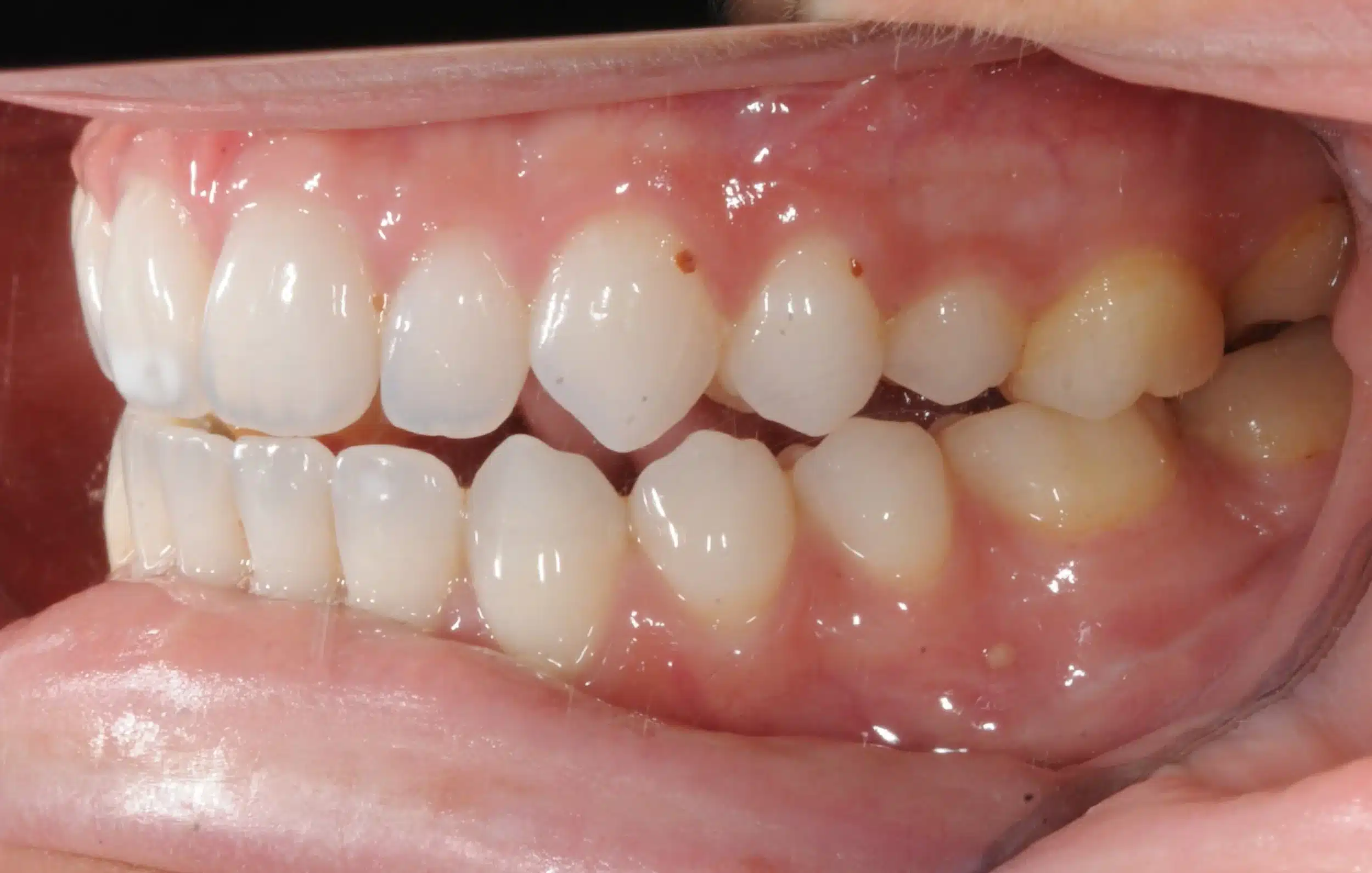 Invisalign begins in 2022 - 130950 - Ines Castro - Diagnostic 17 - Intraoral Left.jpg