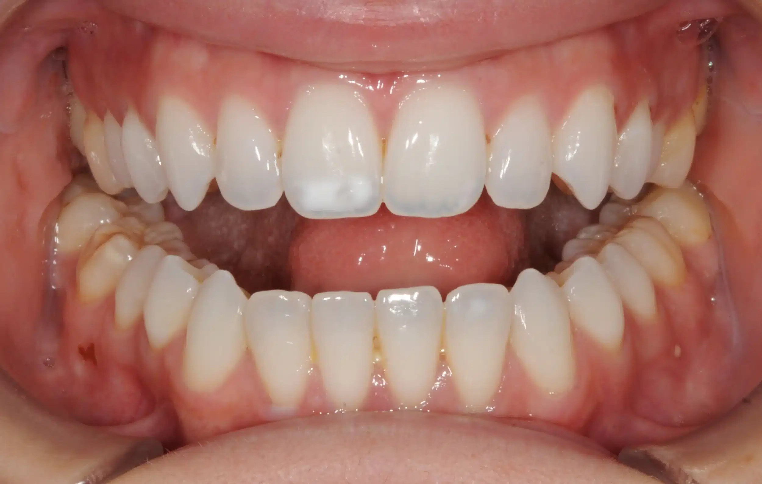 Invisalign begins in 2022 - 130950 - Ines Castro - Diagnostic 17 - Intraoral Misc.jpg