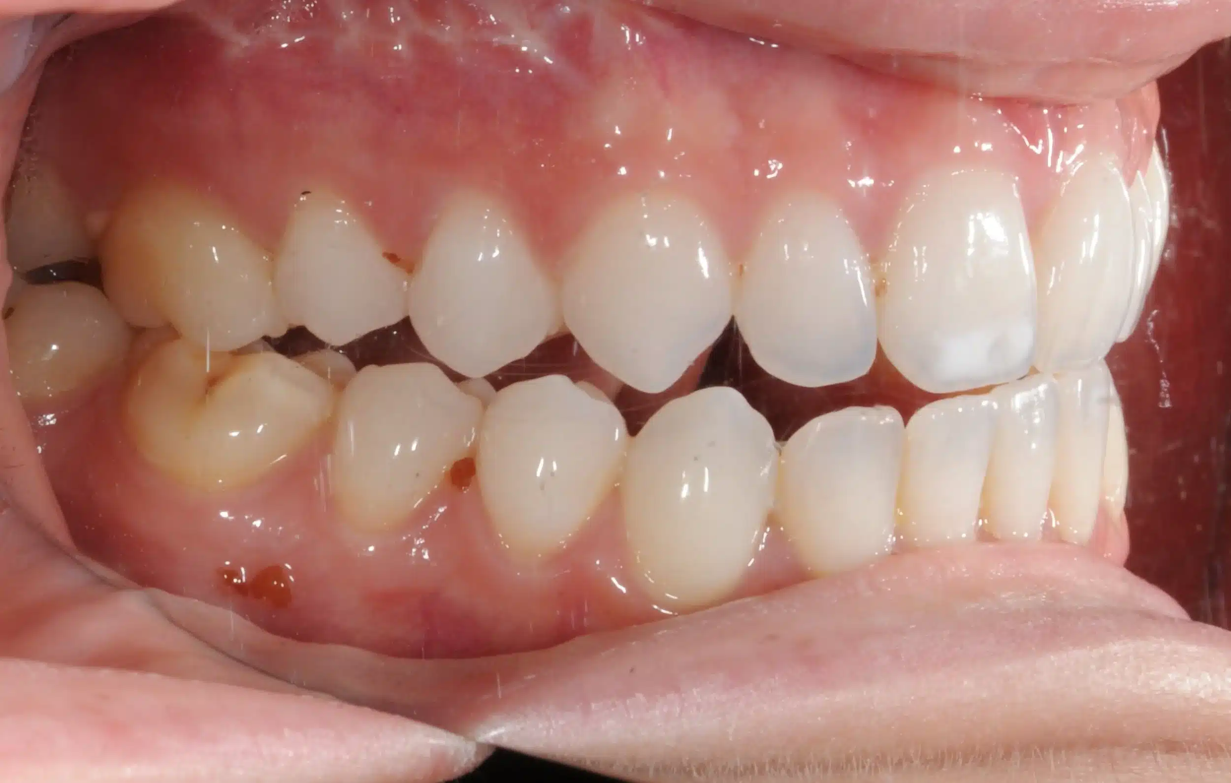 Invisalign begins in 2022 - 130950 - Ines Castro - Diagnostic 17 - Intraoral Right.jpg