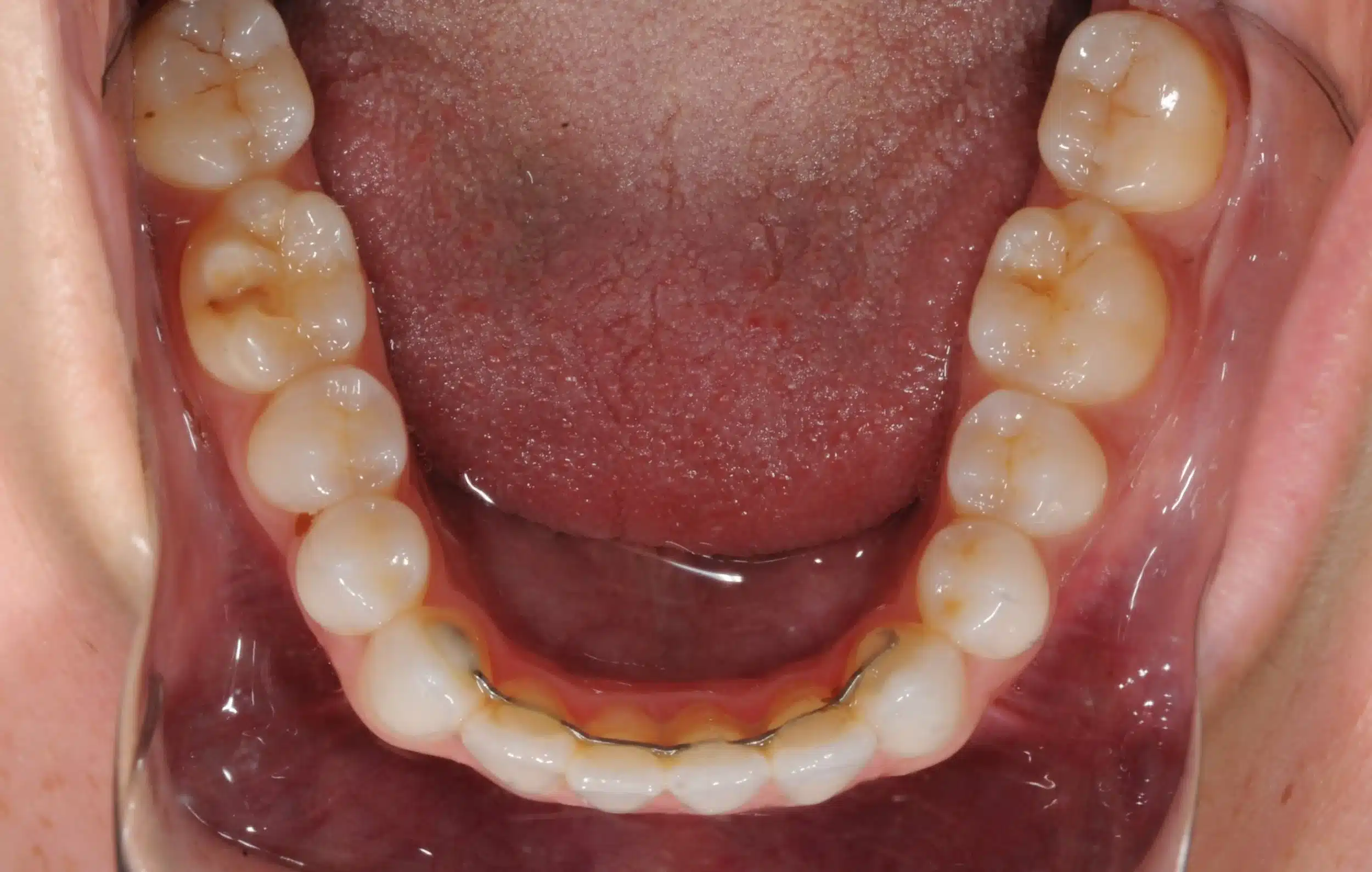 Invisalign begins in 2022 - 130950 - Ines Castro - Diagnostic 17 - Occlusal Lower.jpg