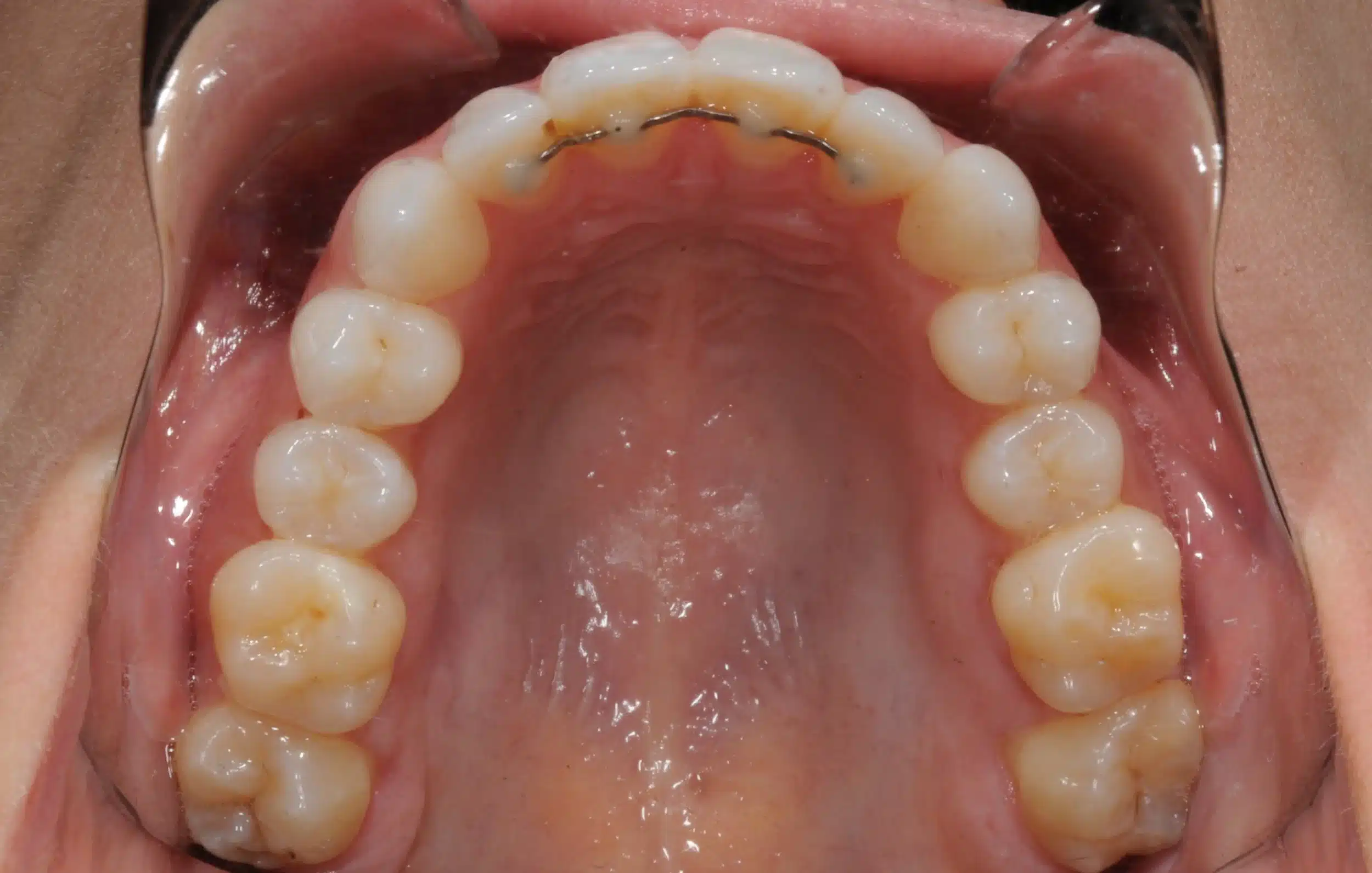Invisalign begins in 2022 - 130950 - Ines Castro - Diagnostic 17 - Occlusal Upper.jpg