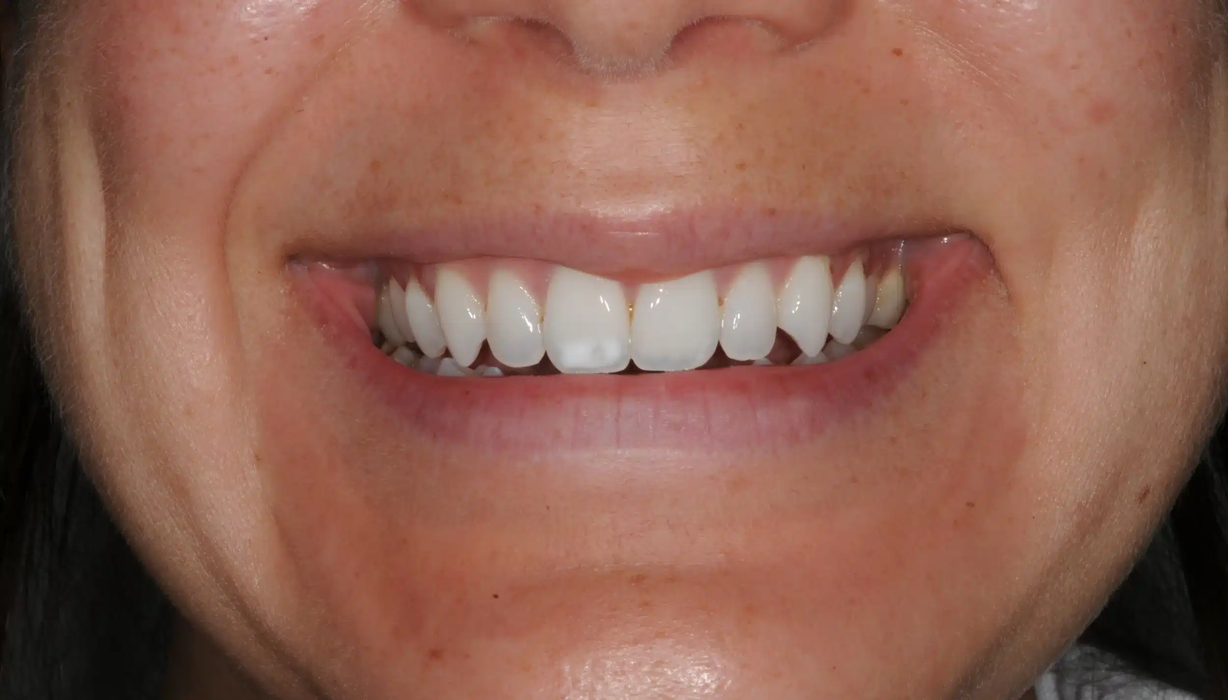 Invisalign begins in 2022 - 130950 - Ines Castro - Diagnostic 17 - Smile.jpg