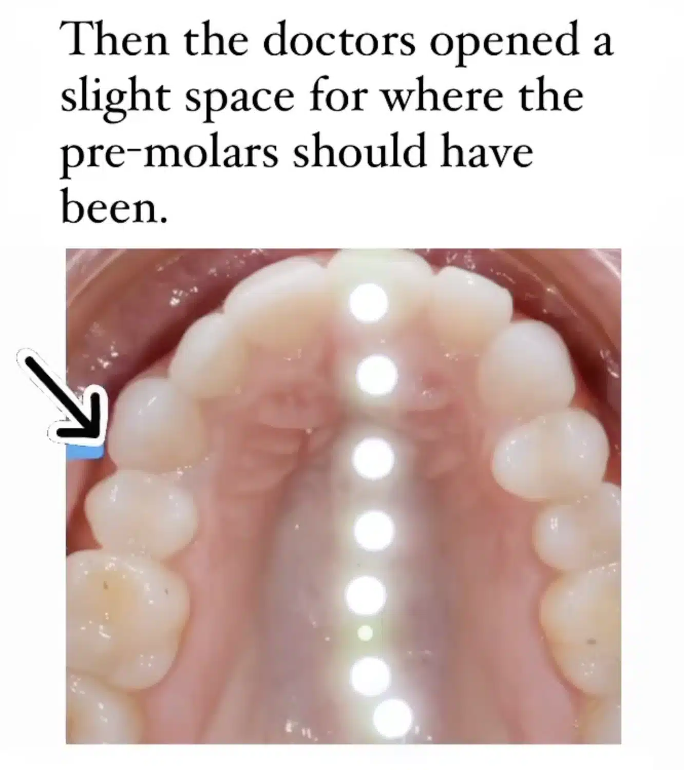 premolar1.png