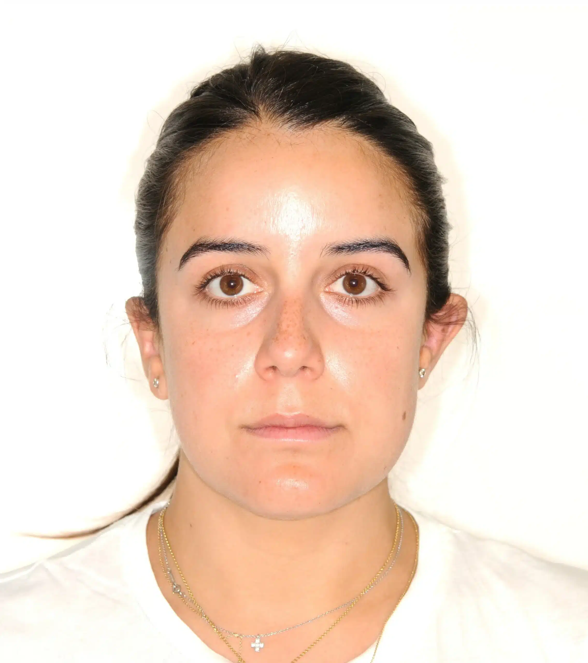 retention four years later relapse 5-25-2021 - 130950 - Ines Castro - Retention 40 - Facial Front.jpg