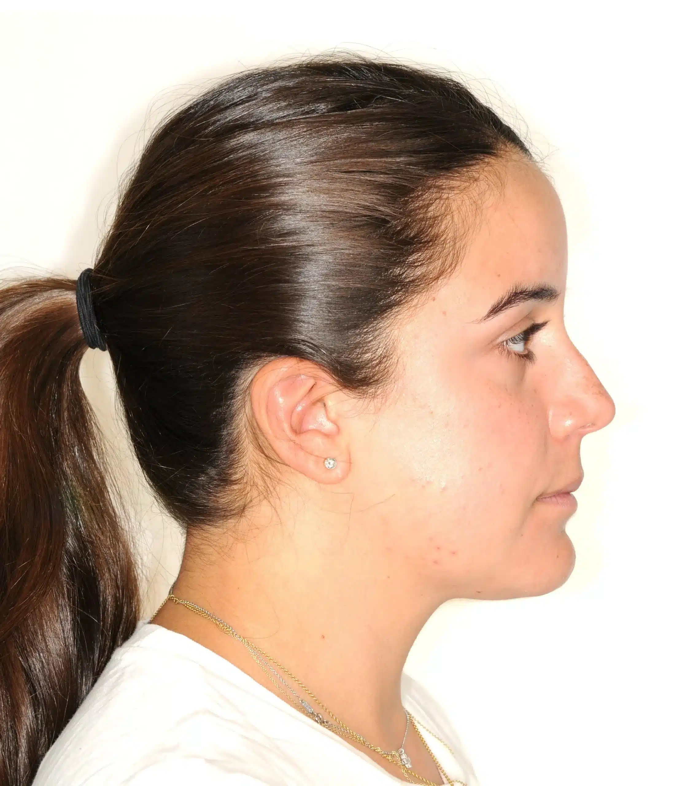 retention four years later relapse 5-25-2021 - 130950 - Ines Castro - Retention 40 - Facial Profile.jpg