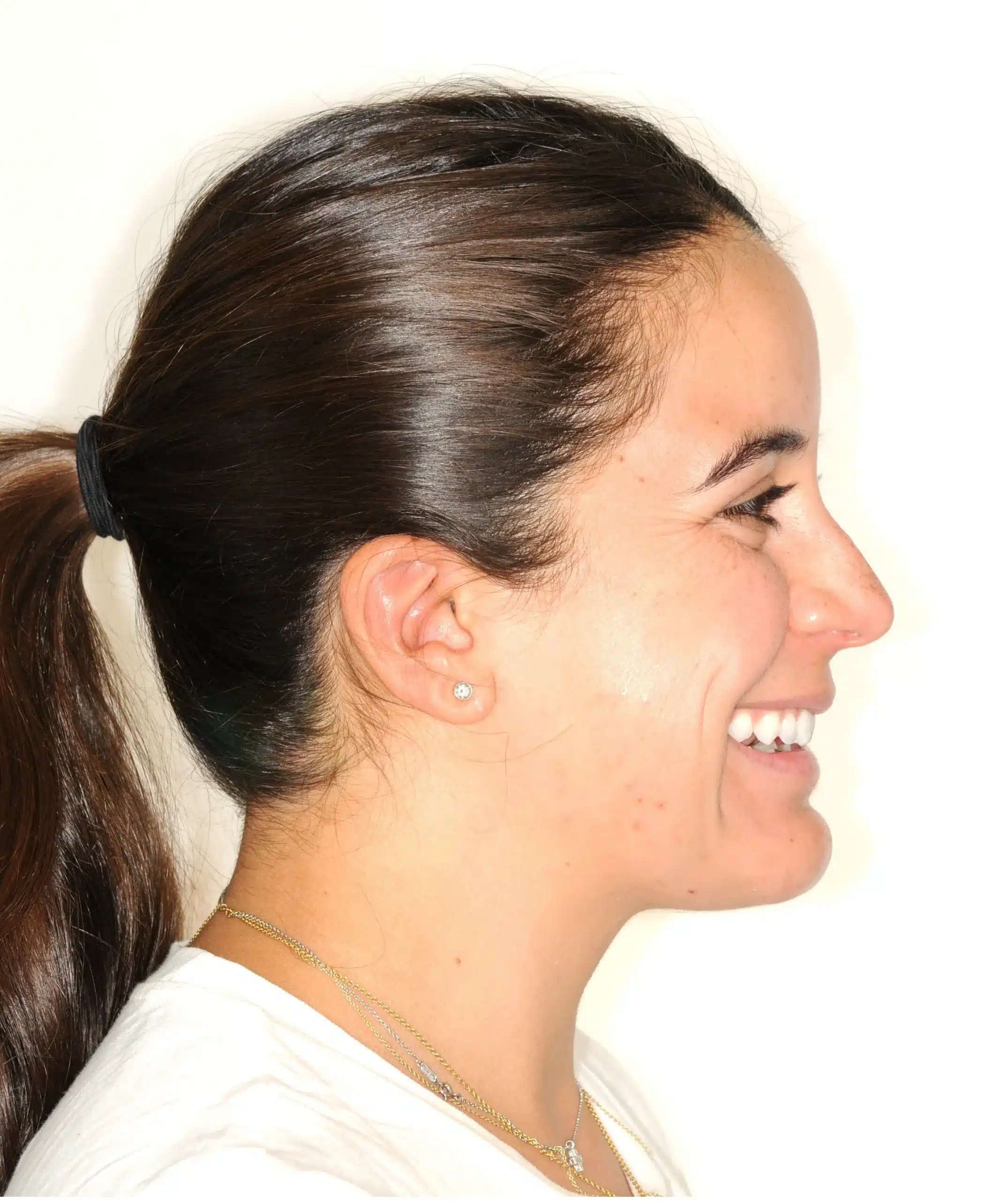 retention four years later relapse 5-25-2021 - 130950 - Ines Castro - Retention 40 - Facial Profile Smiling.jpg