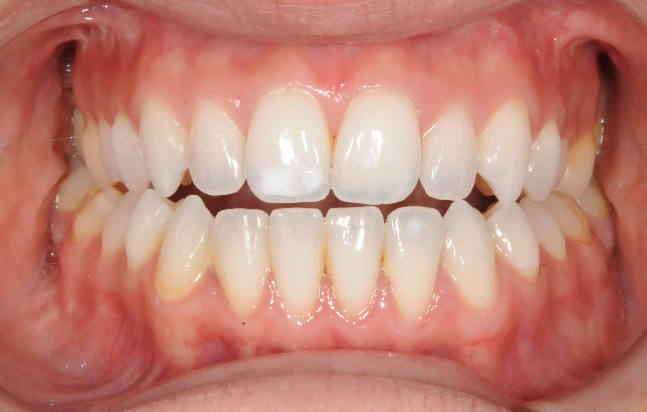 retention four years later relapse 5-25-2021 - 130950 - Ines Castro - Retention 40 - Intraoral Center.jpg