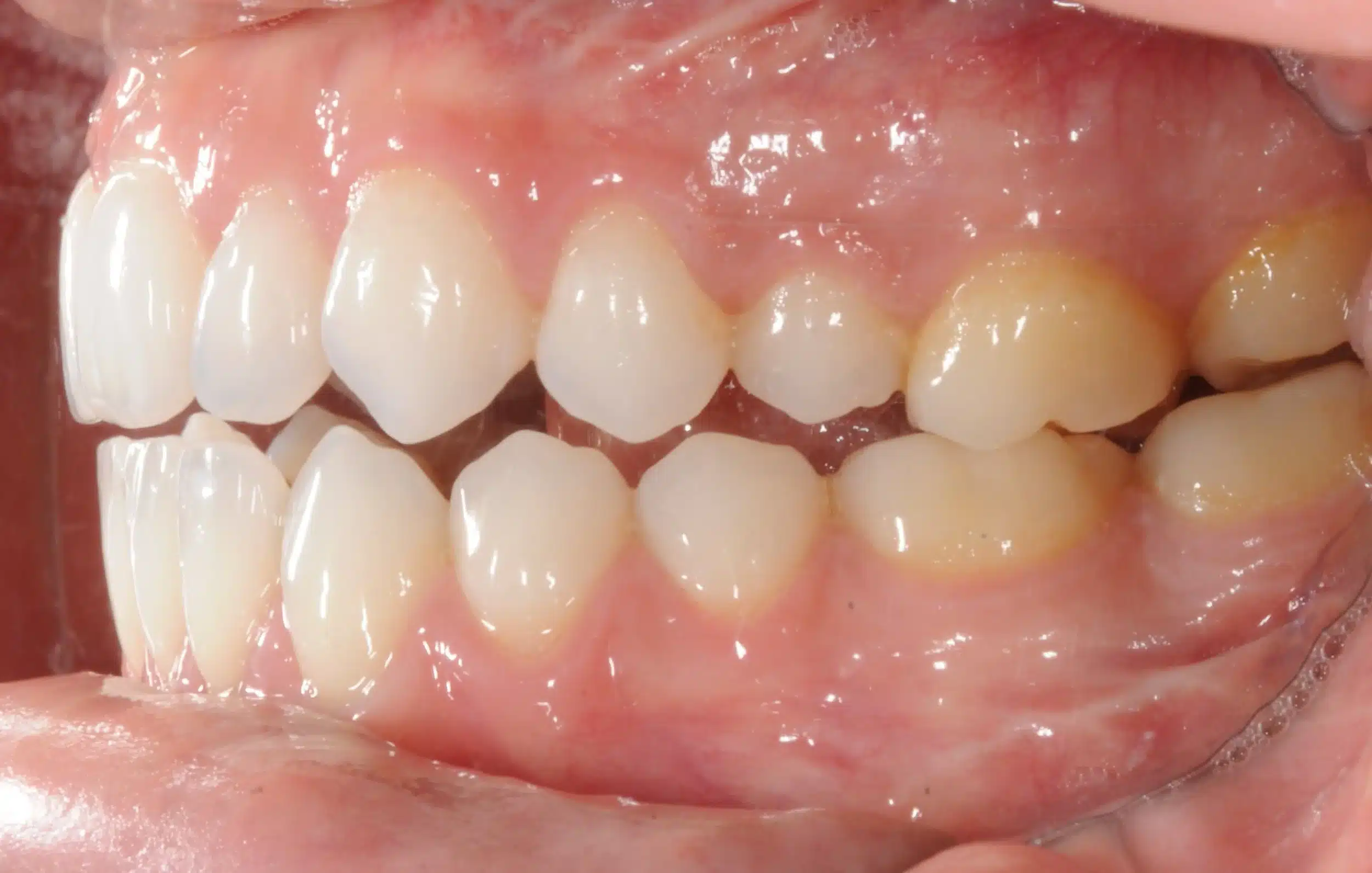 retention four years later relapse 5-25-2021 - 130950 - Ines Castro - Retention 40 - Intraoral Left.jpg