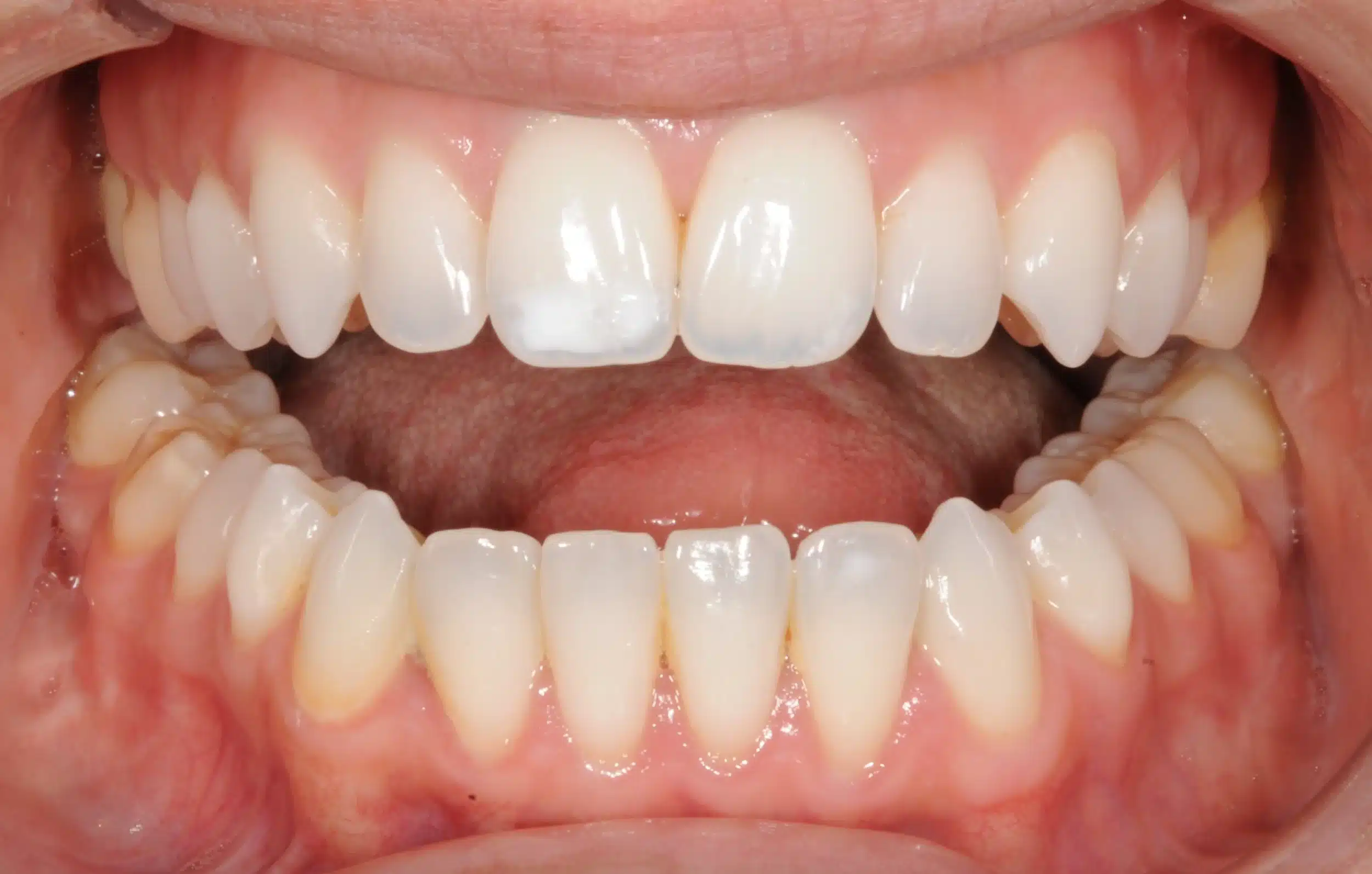 retention four years later relapse 5-25-2021 - 130950 - Ines Castro - Retention 40 - Intraoral Misc.jpg