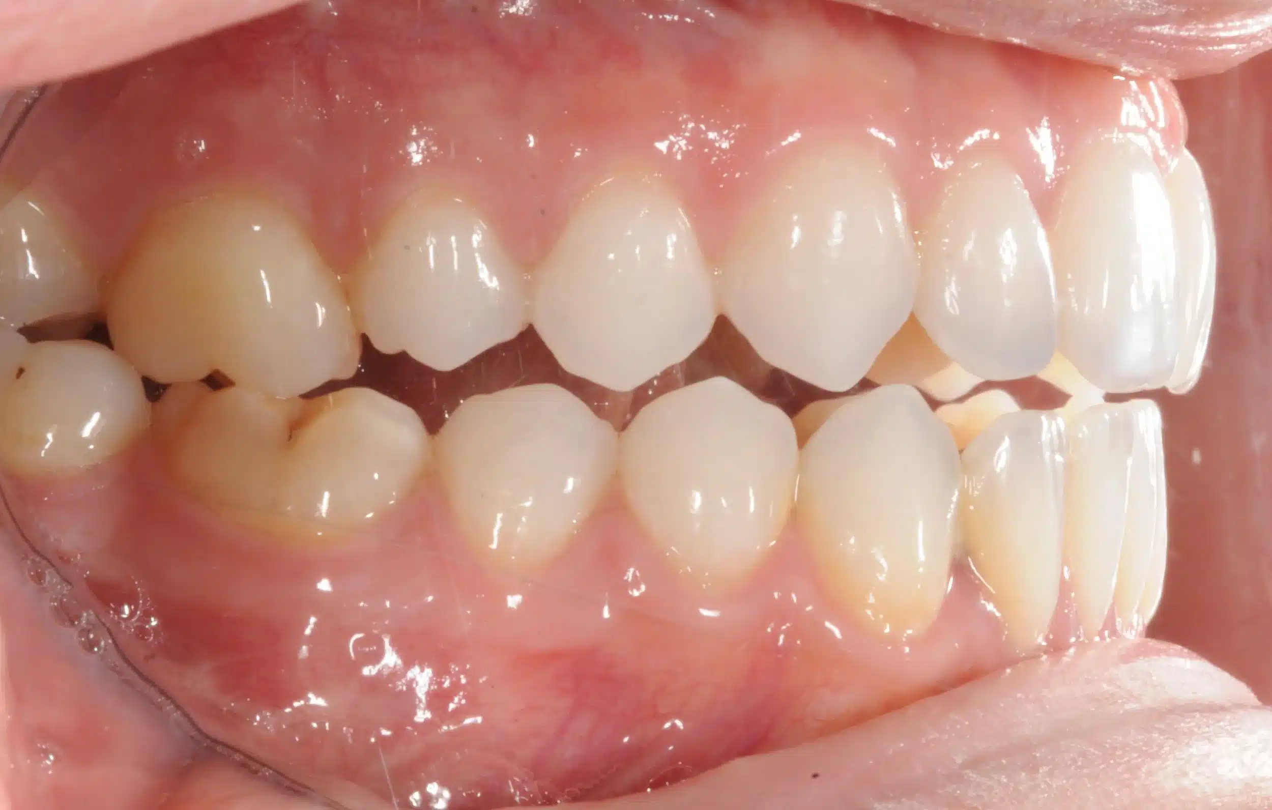 retention four years later relapse 5-25-2021 - 130950 - Ines Castro - Retention 40 - Intraoral Right.jpg